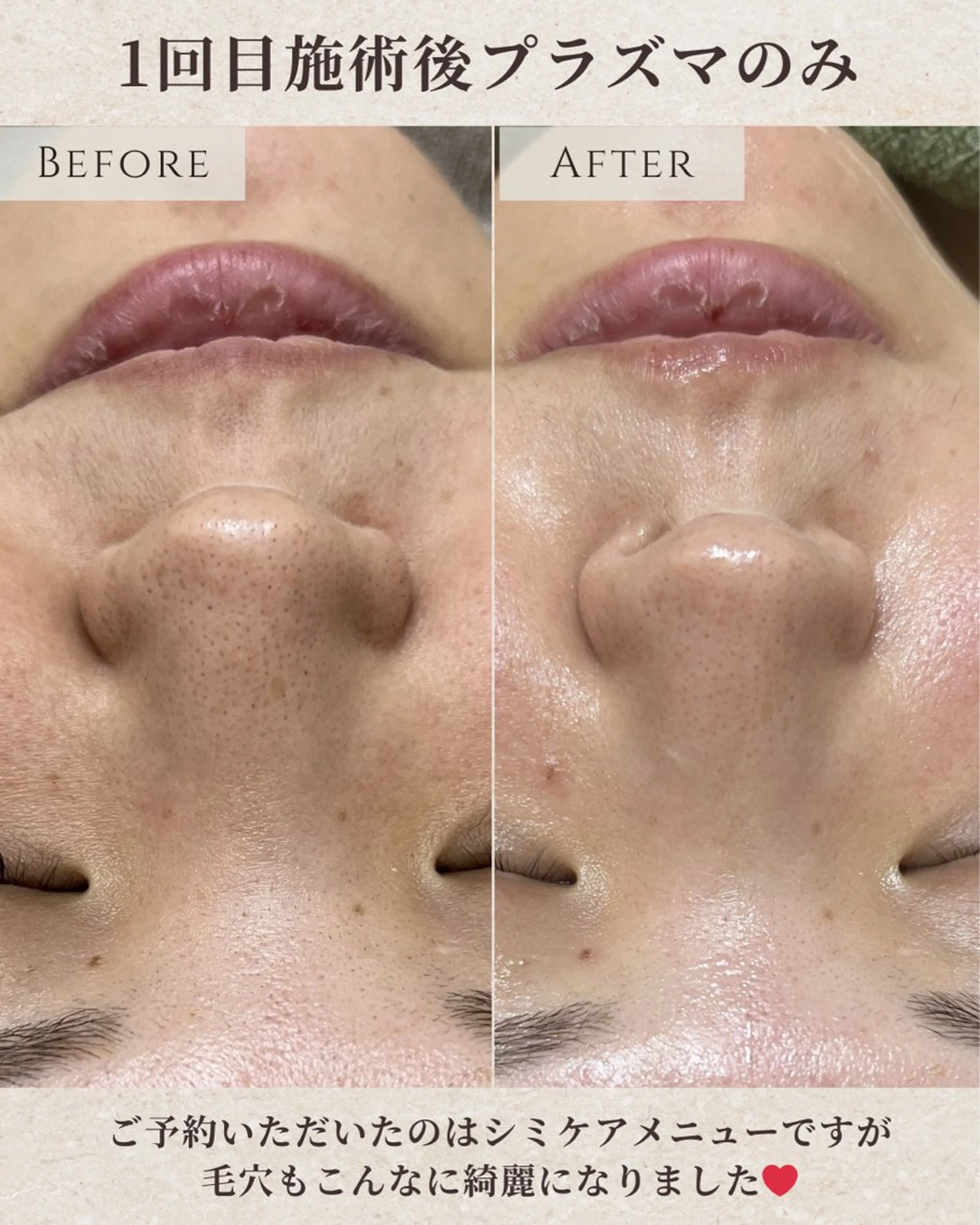 エステ シミ毛穴|眉Wax THE  flowのエステ・リラクイメージ