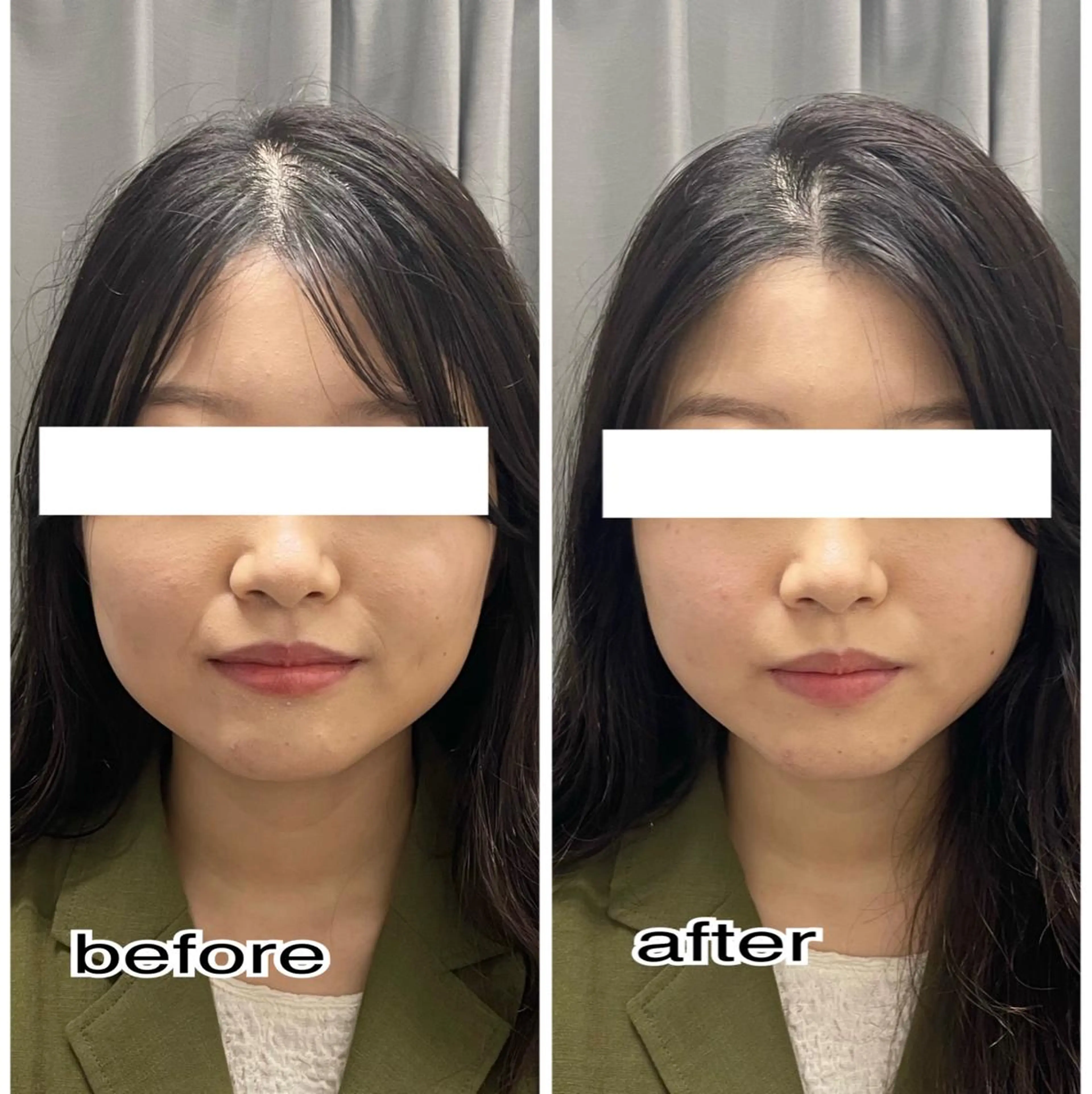 小顔造形!【3D×顔特化】W打ち🌿🤍No.1メニュー//😊の写真