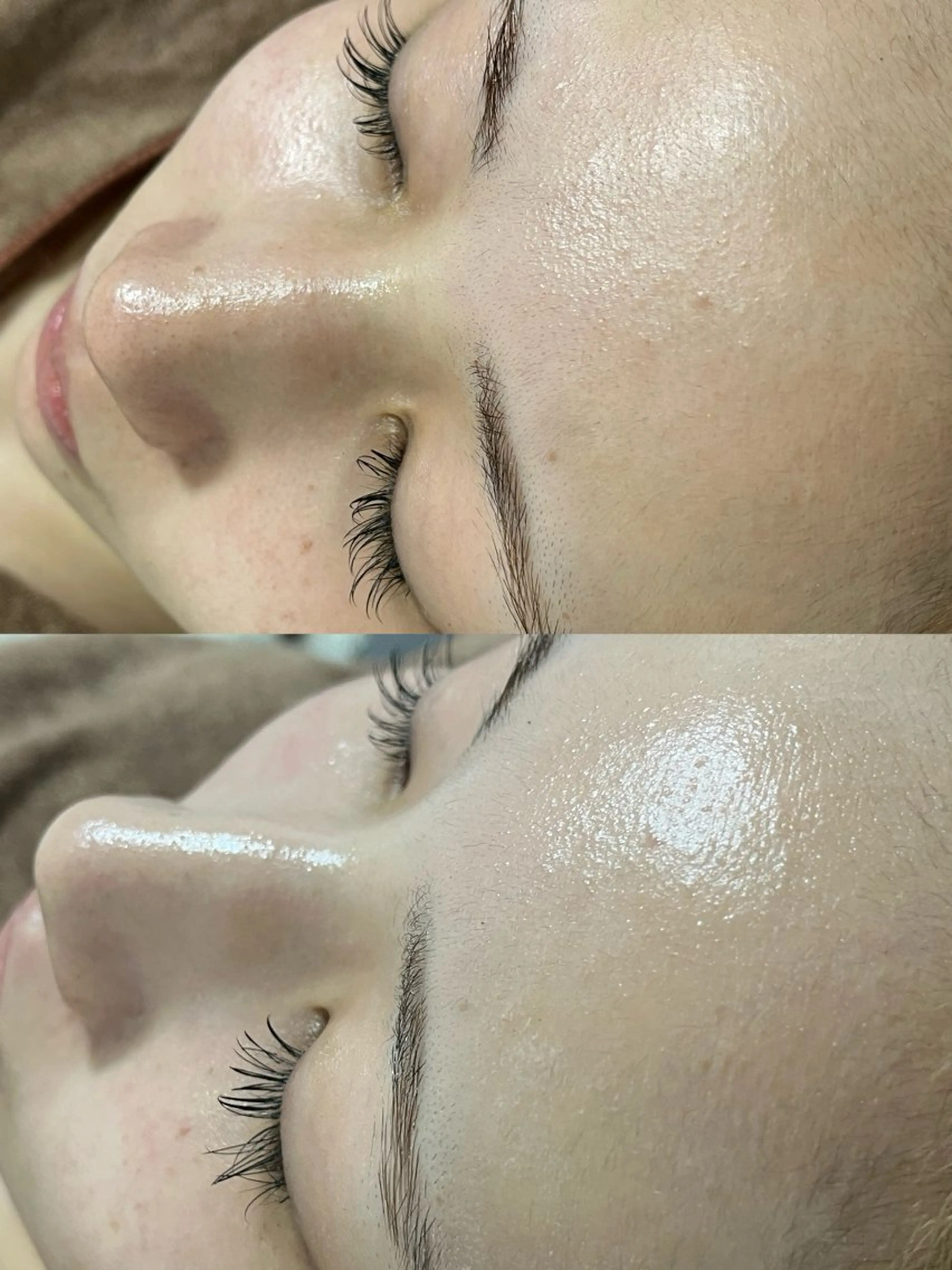 ニキビ／毛穴ケア ハーブピーリングのエステ・リラクイメージ