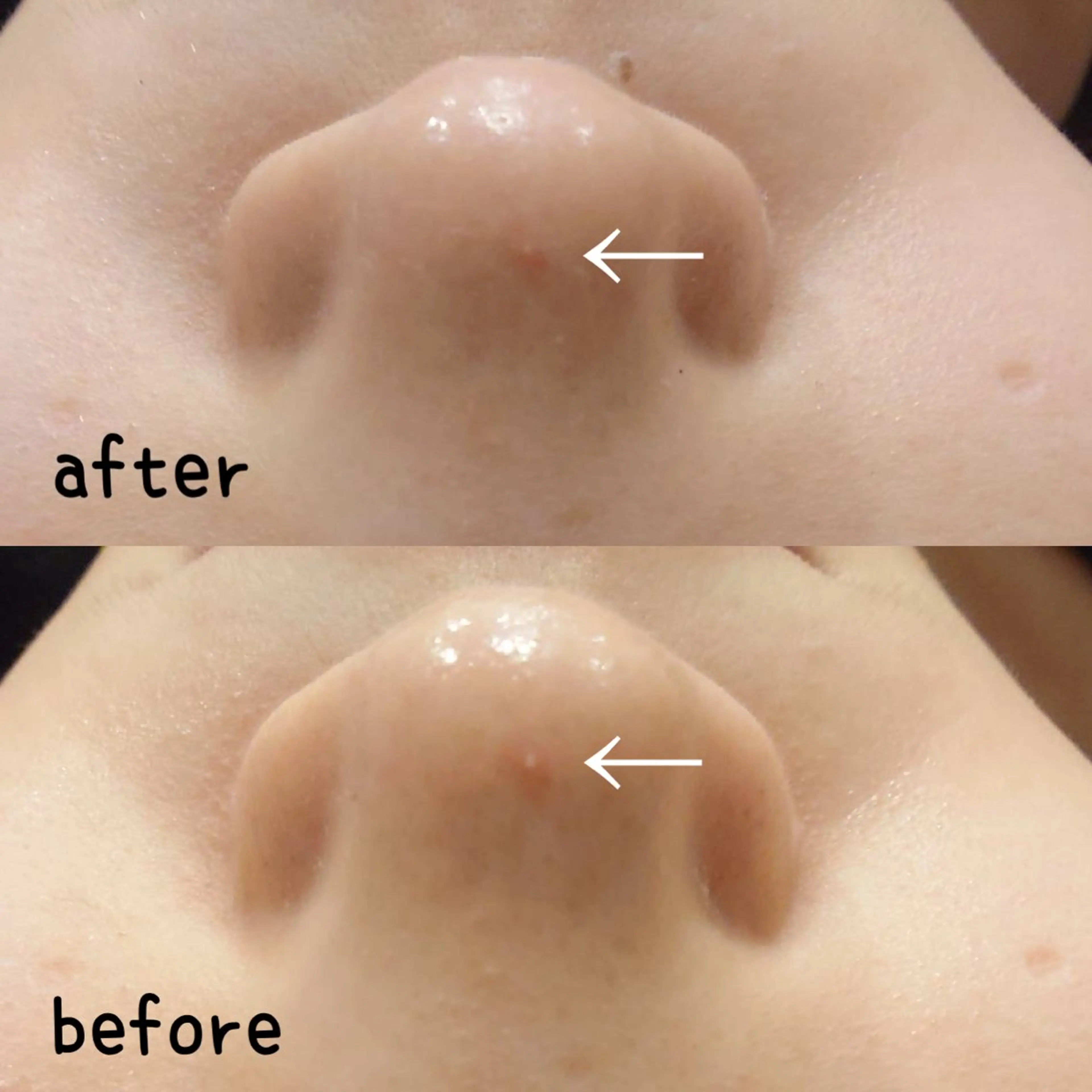 小顔&整体コルギ＆ハーブピーリング✨80分の写真