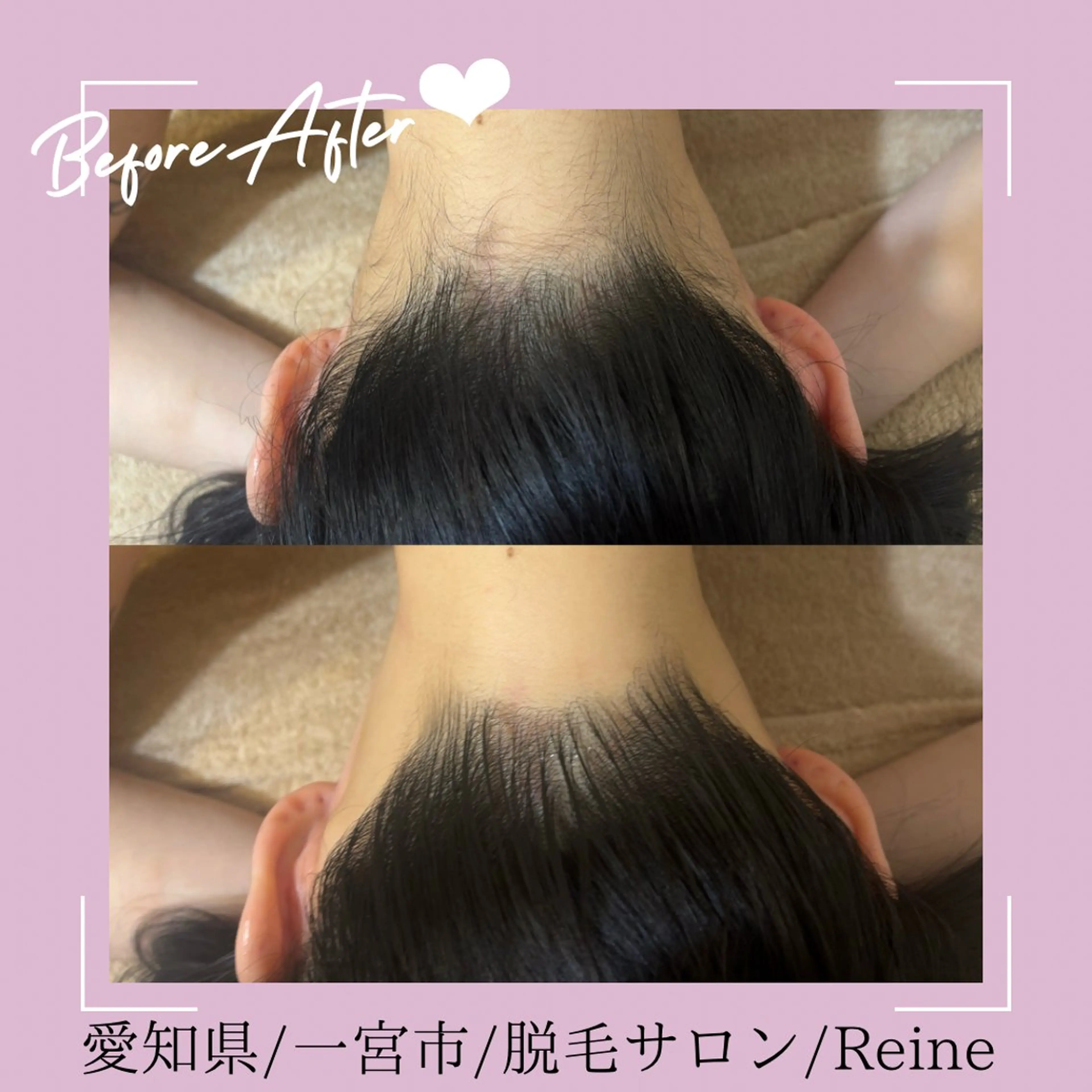脱毛 Reine BeautySalon所属・毛穴/シミ肝斑/脱毛 横山梨里のエステ・リラクイメージ