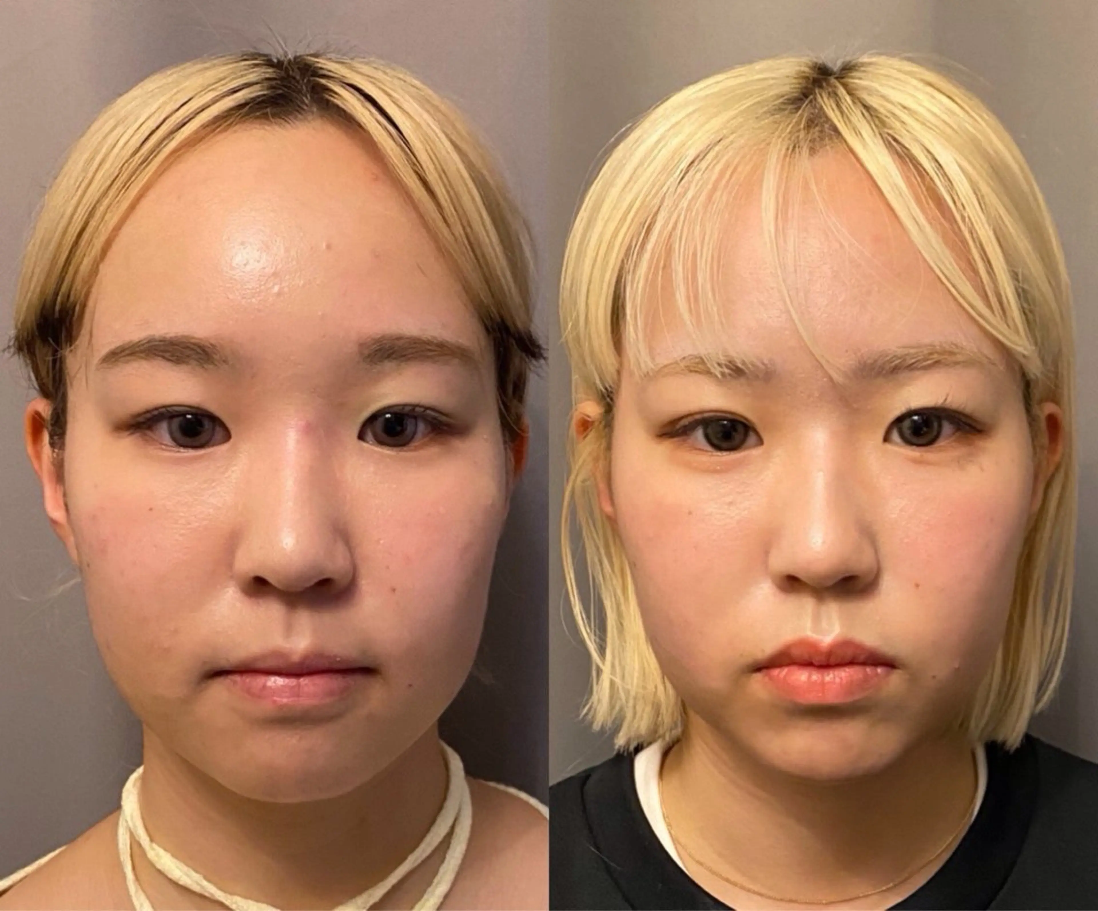 医療提携×美容整体 小顔ハイフピーリングのエステ・リラクイメージ