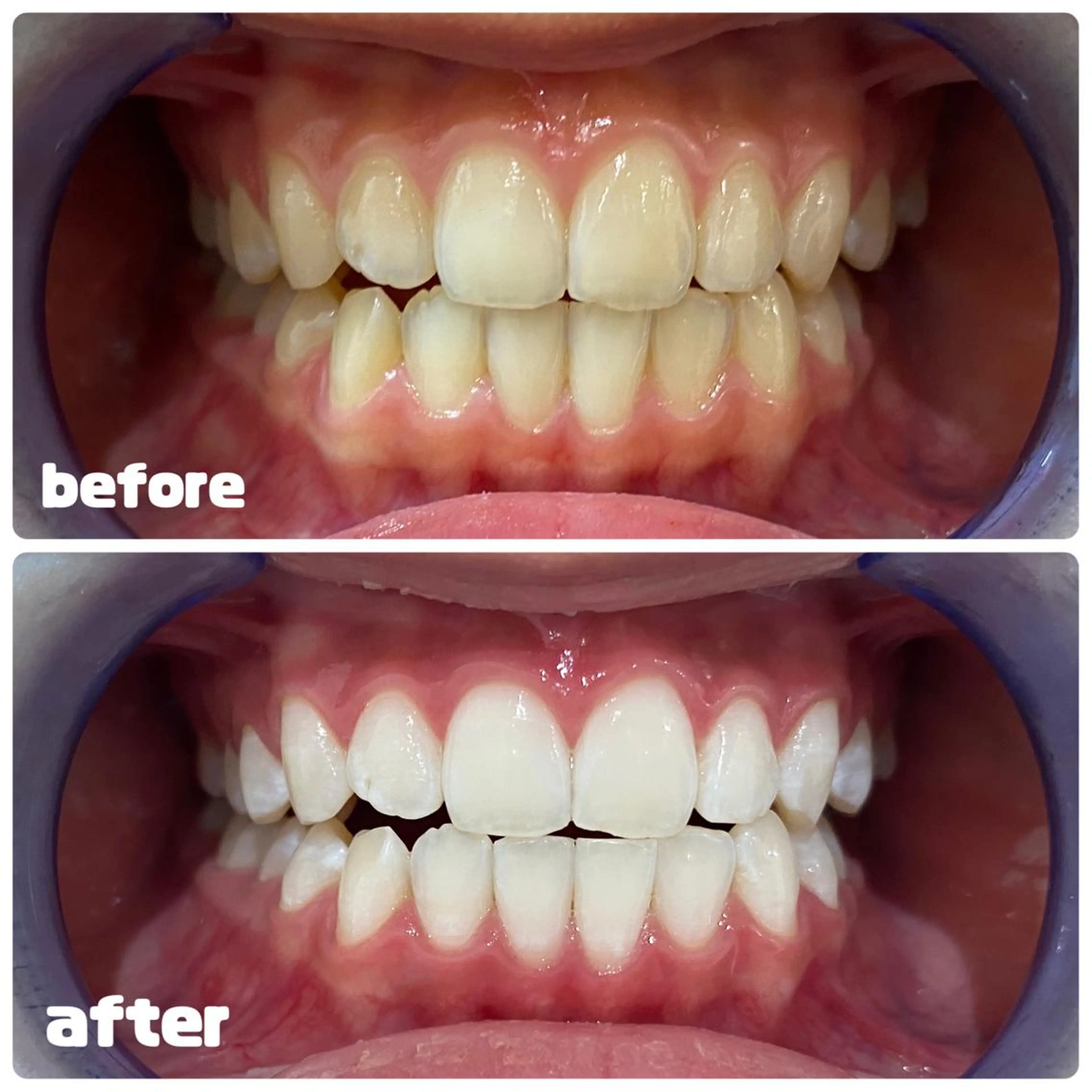 【シルバープラン&ゴールドプラン】セルフホワイトニング 各15分 計30分照射の写真