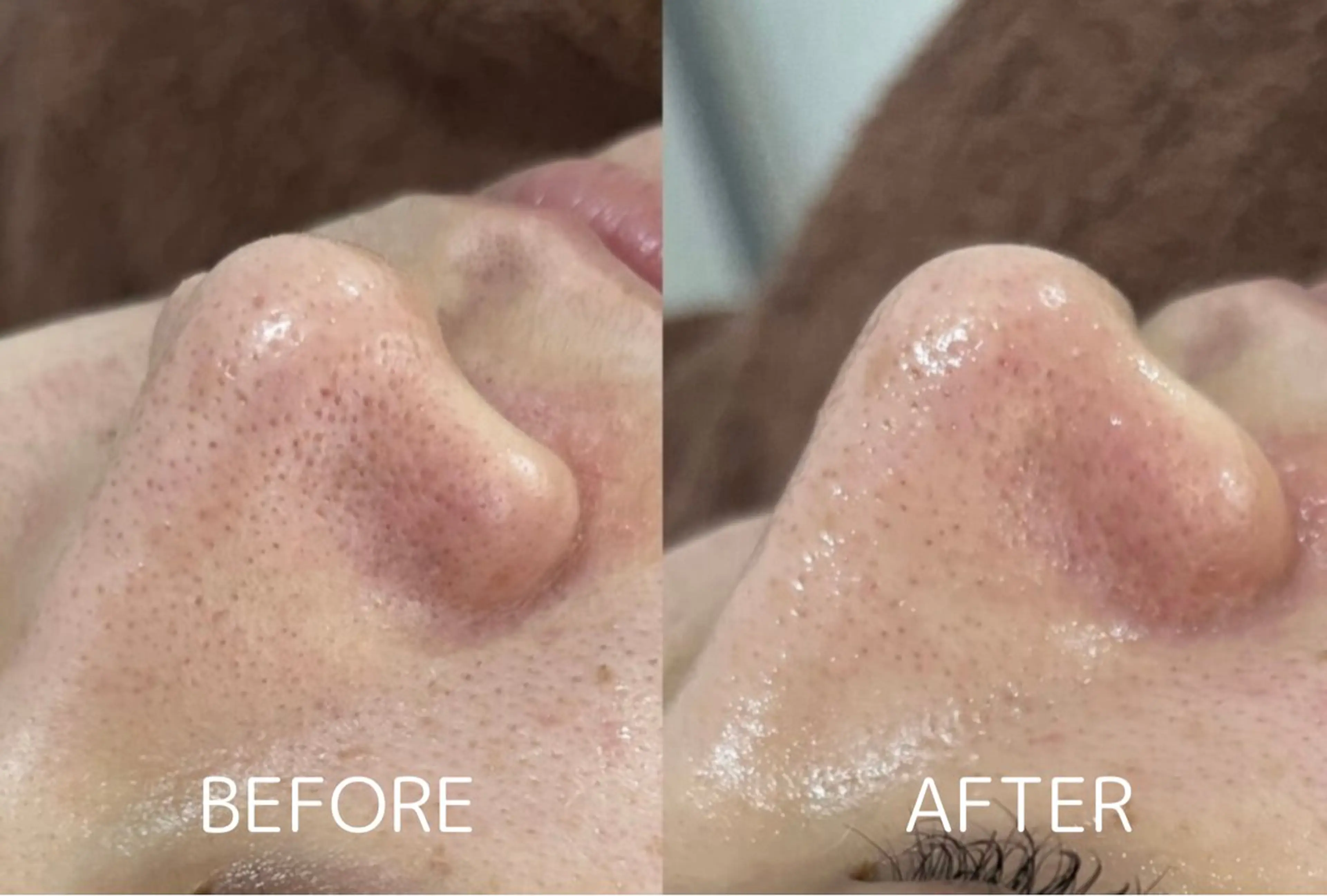 【毛穴黒ずみ】毛穴の詰まりを瞬時に解放・クリアな肌の第一歩へ¥5000→¥4500の写真