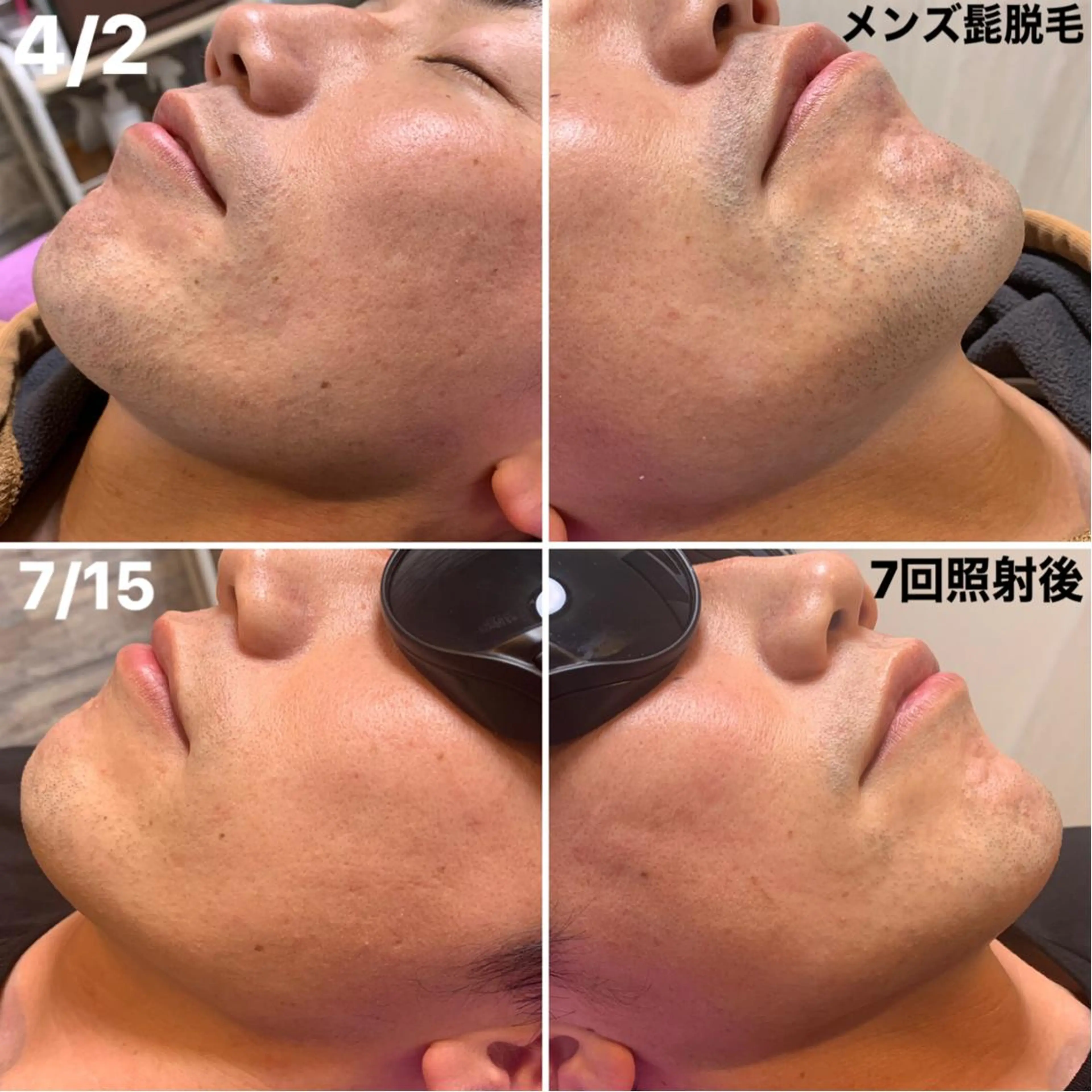 メンズ 脱毛＆エステサロン【アンリミット】所属・森谷 莉美のエステ・リラクイメージ