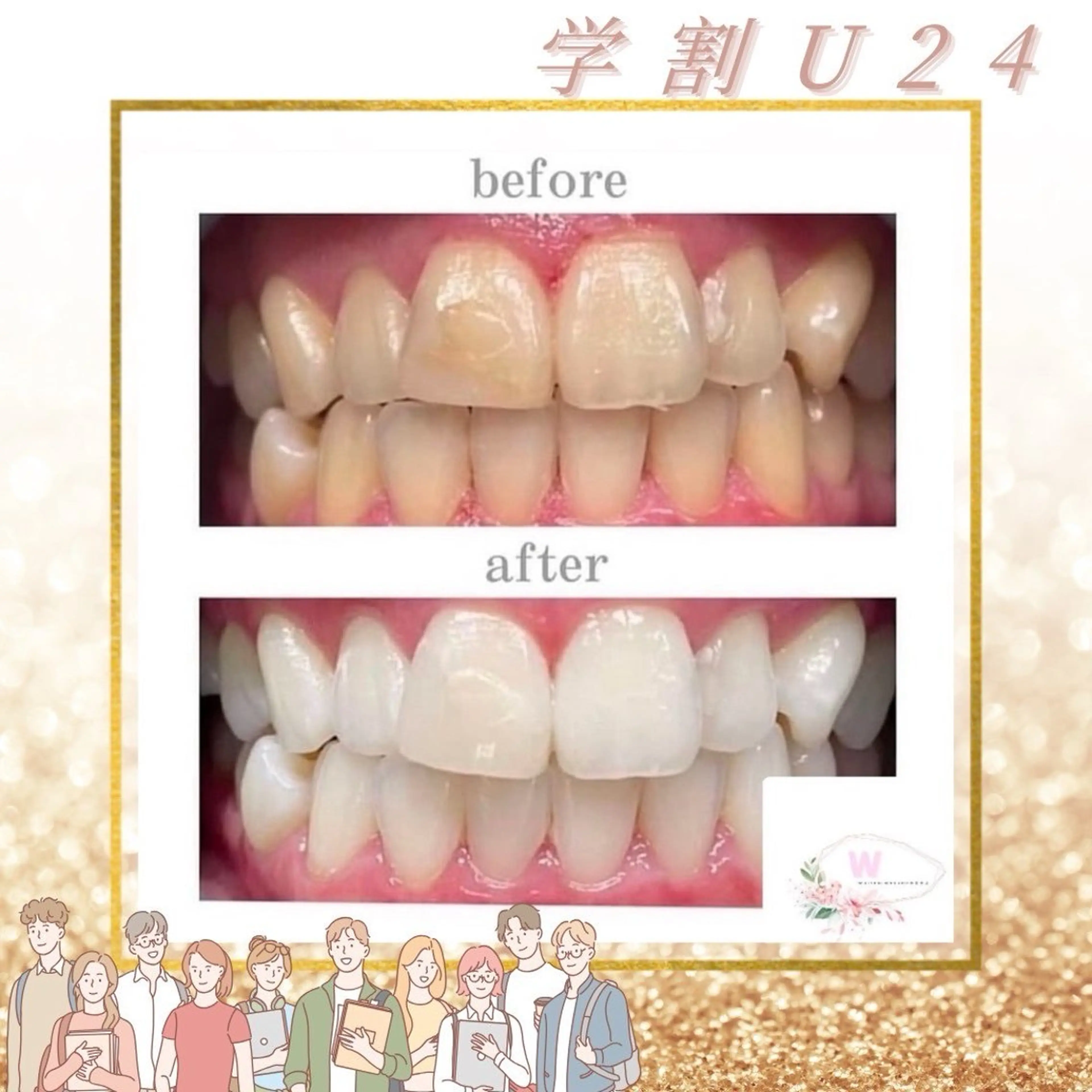 【学生初回限定】印象🆙を叶える🎶セルフホワイトニング40分¥6980→¥2500※口コミ条件の写真