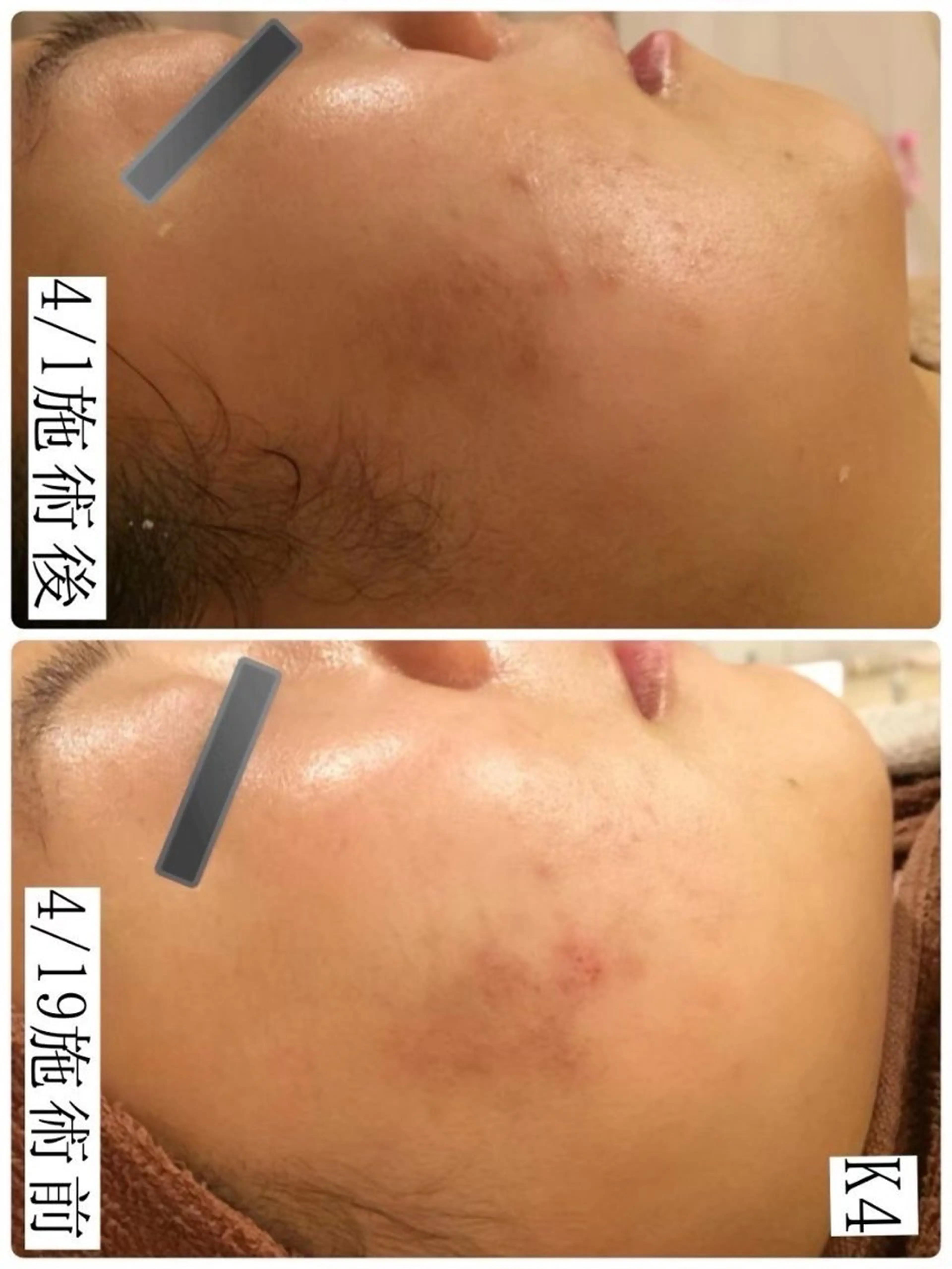 学生ニキビ改善🍀 優しい肌質改善のエステ・リラクイメージ