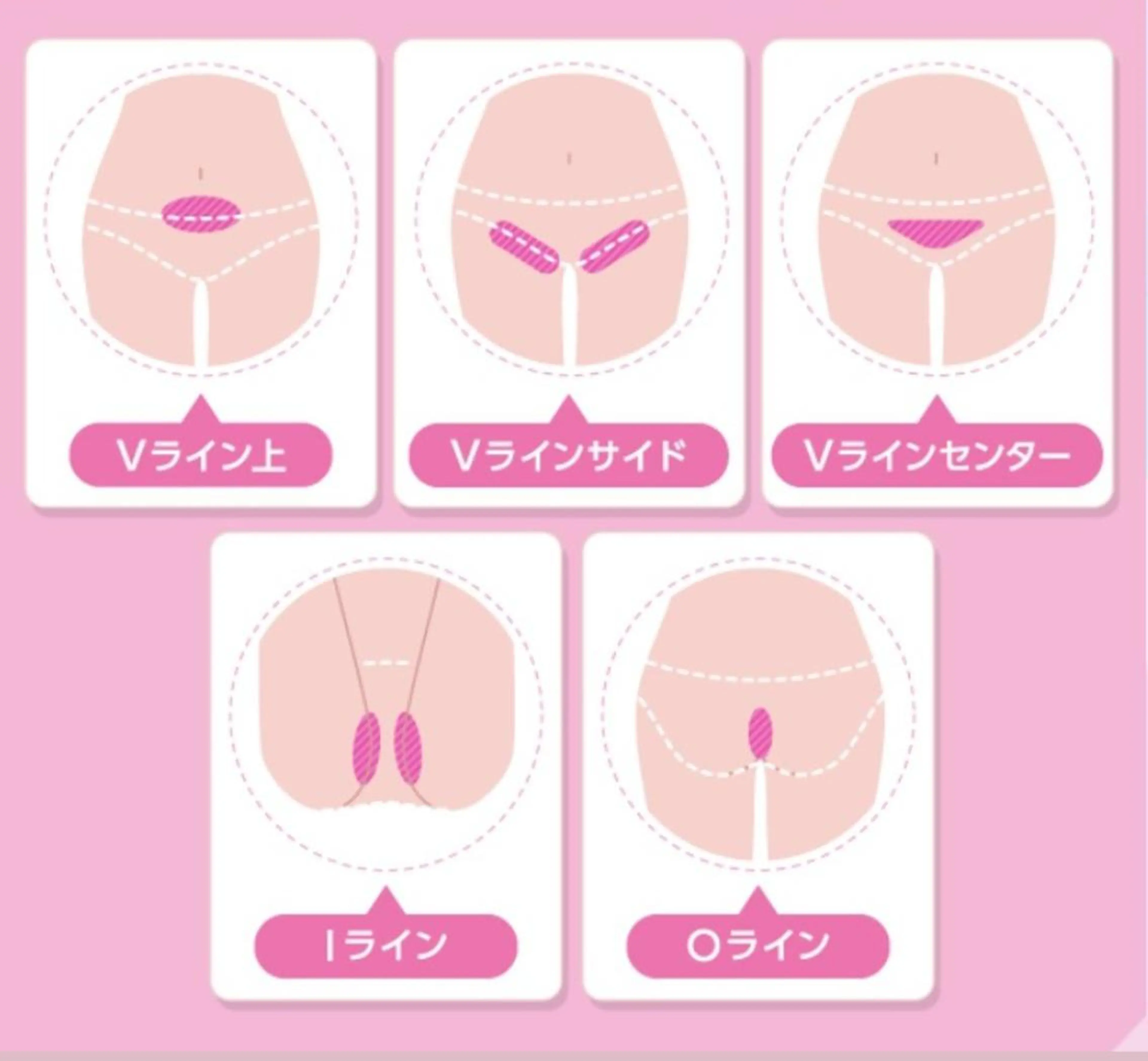 U24🎀シェービング付VIO脱毛🎀冷却機能・デザイン自由・美白👌本気で毛をなくしたい方へ💍目指せ自己処理卒業🌟の写真