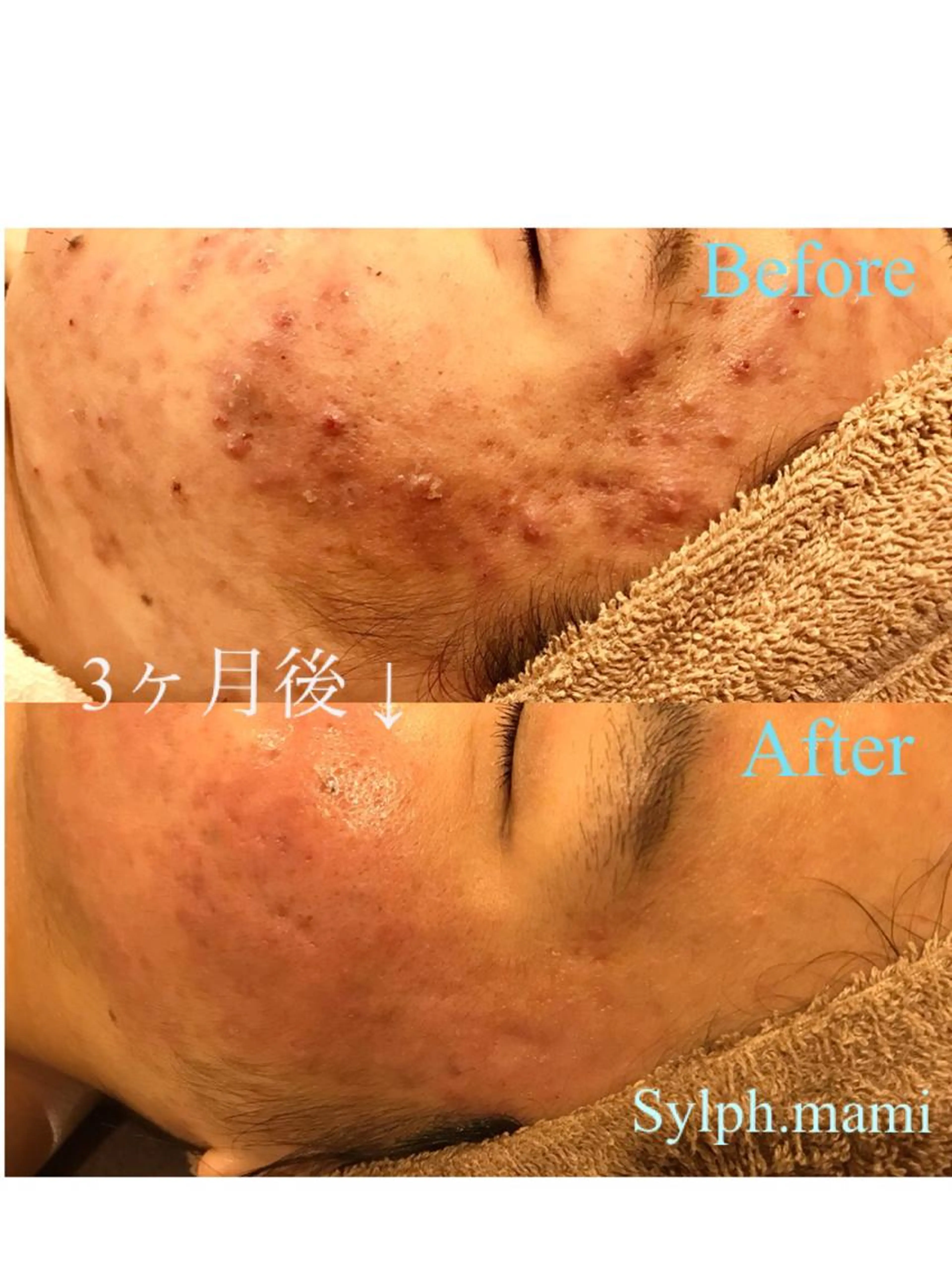 【毛穴開きや皮脂テカリ&ニキビ肌に】汚れの溜まった毛穴お掃除とニキビ肌の皮脂コントロールエステ✨の写真