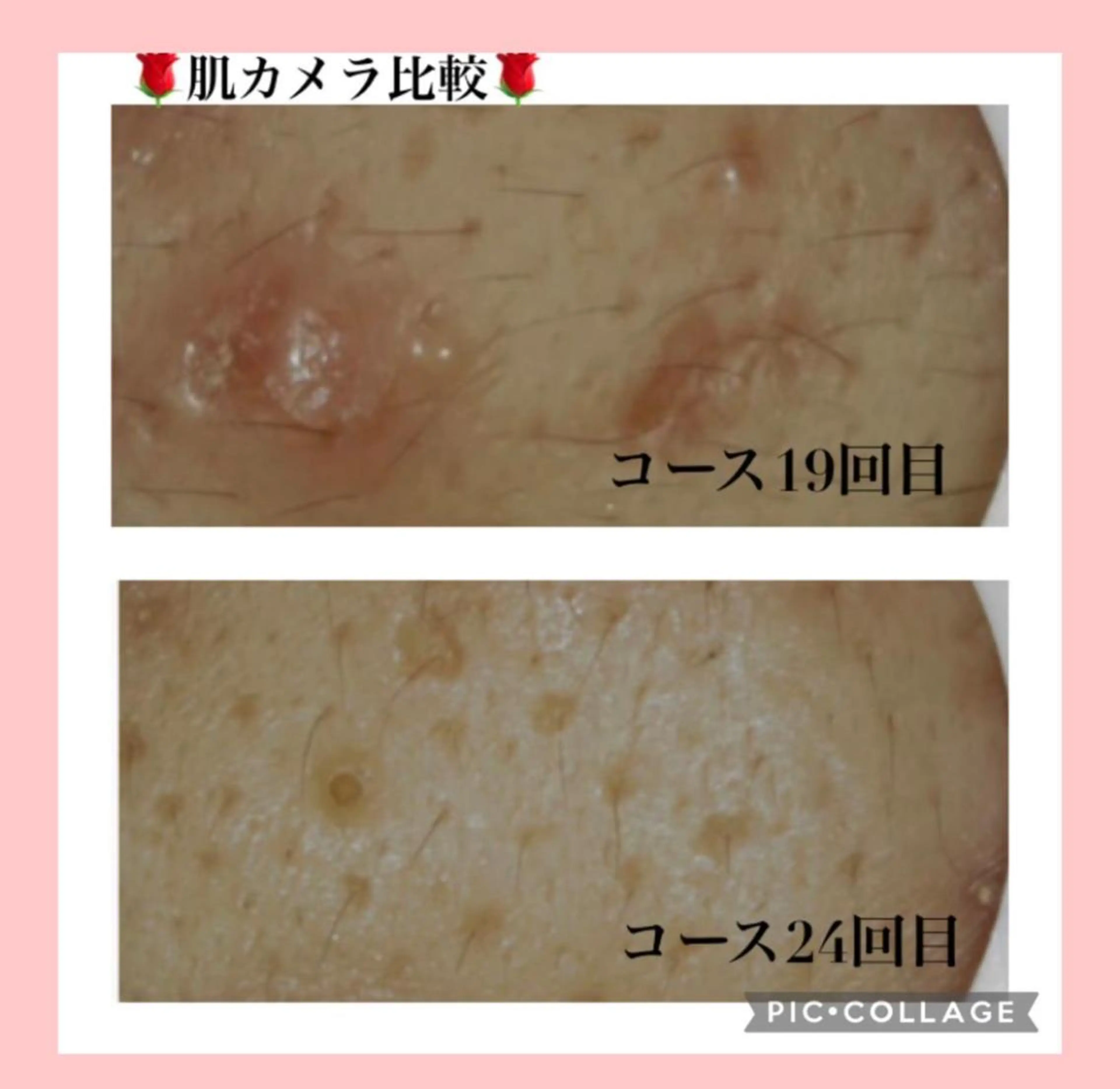 🔥3か月で肌革命 🔥ニキビ専門店のエステ・リラクイメージ