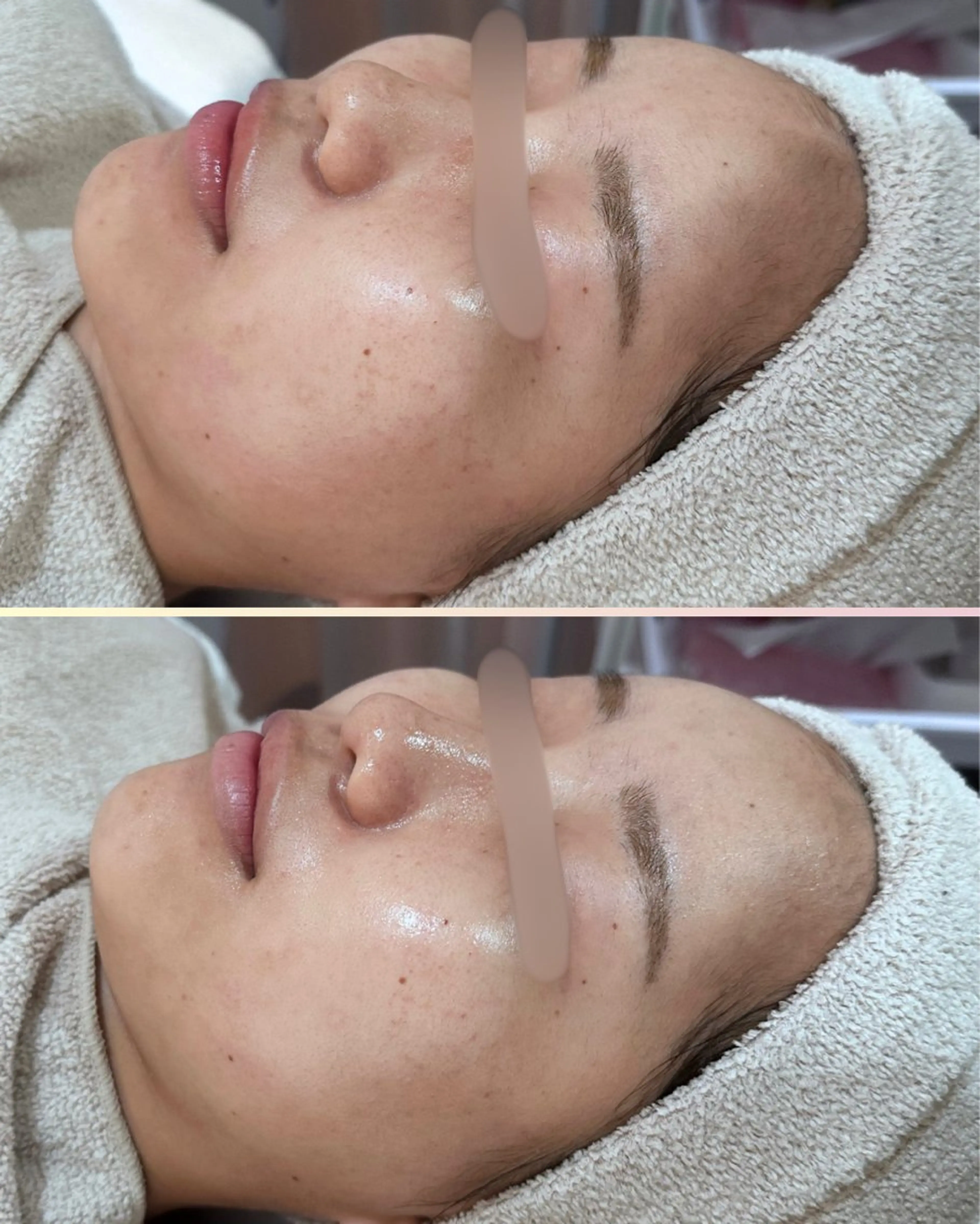 エステ |ピーリング・毛穴| soina神楽坂のエステ・リラクイメージ