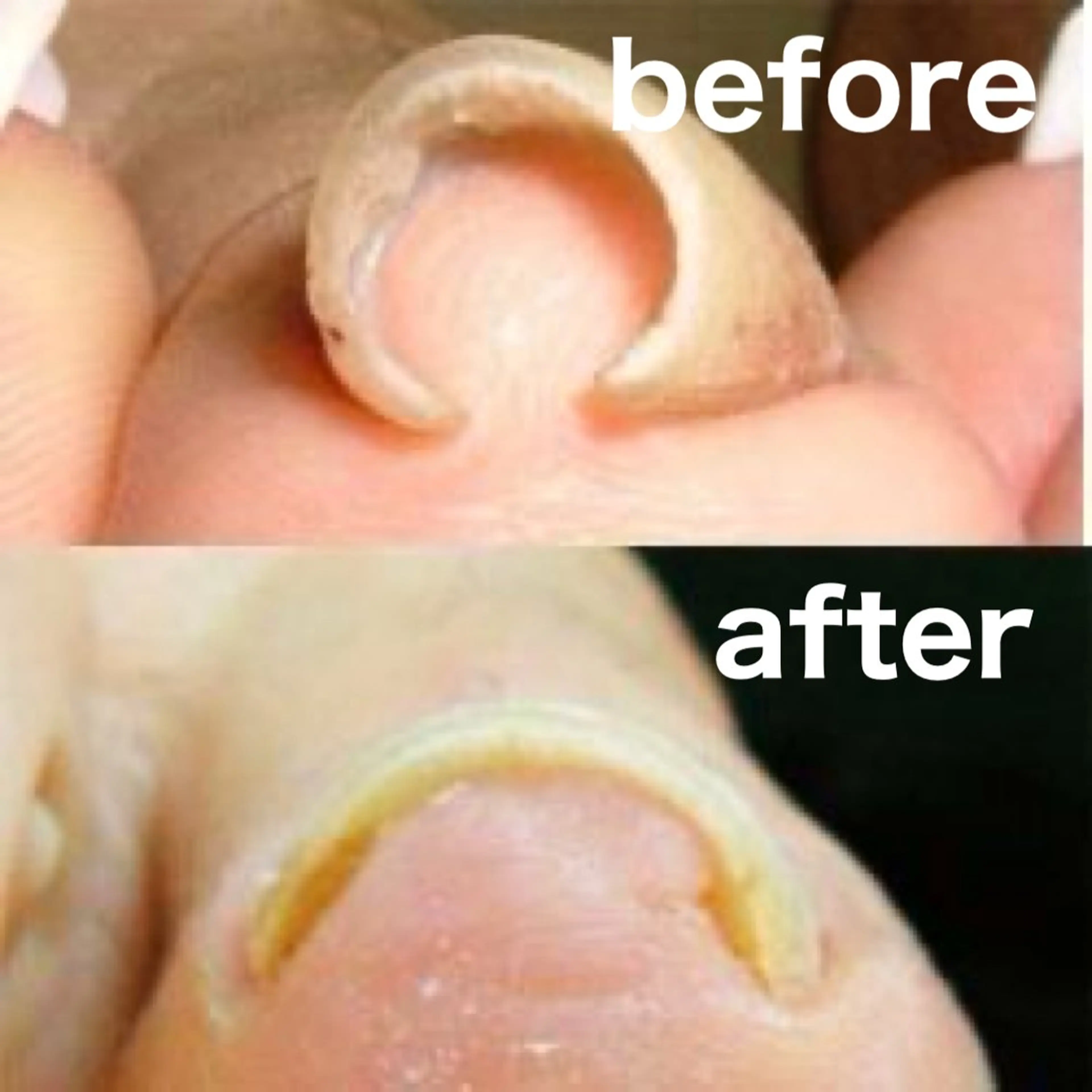 巻き爪補正１箇所　初回限定の写真