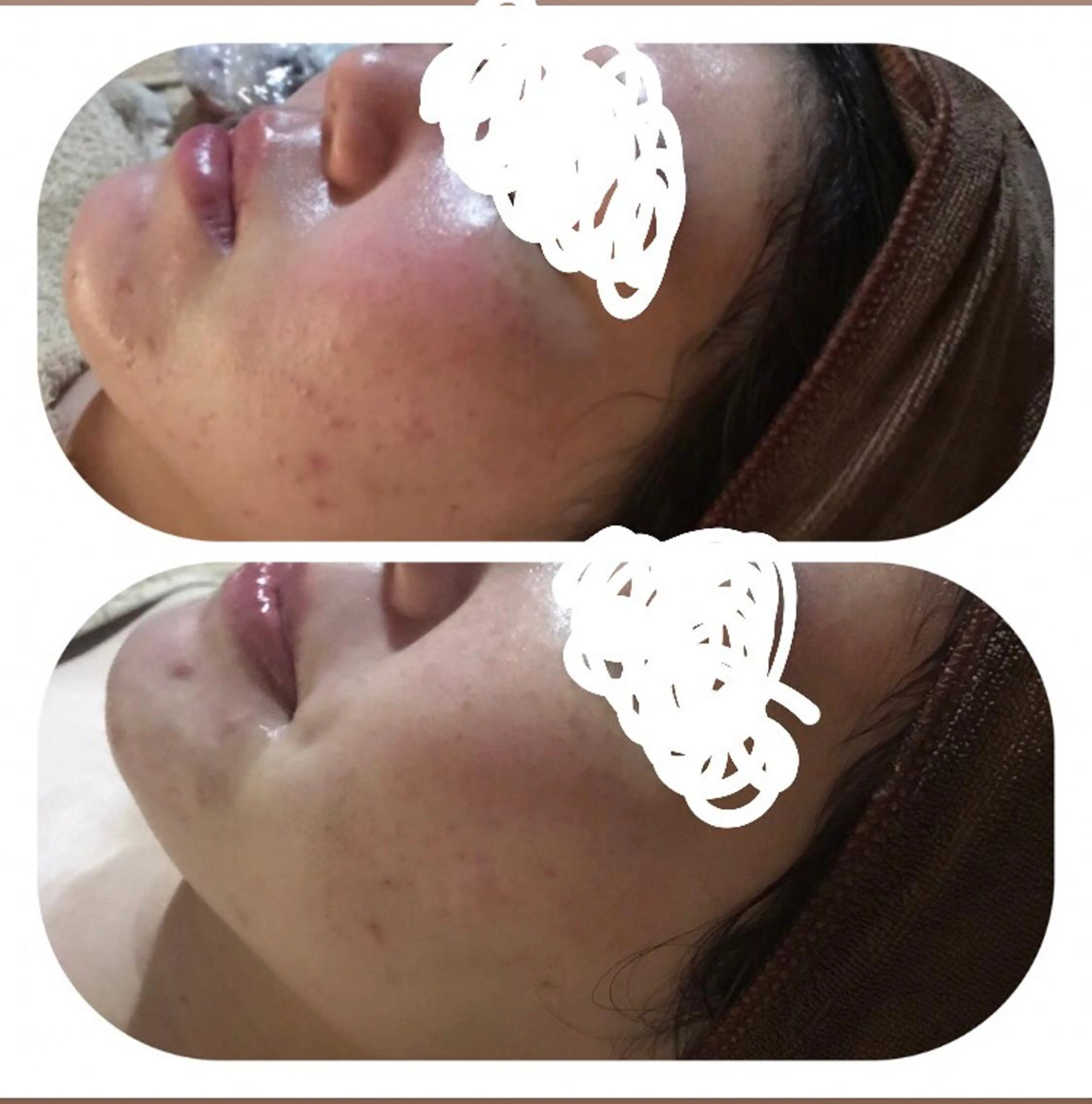 【女性限定】肌荒れをつるつる肌へお顔ゴマージュの写真