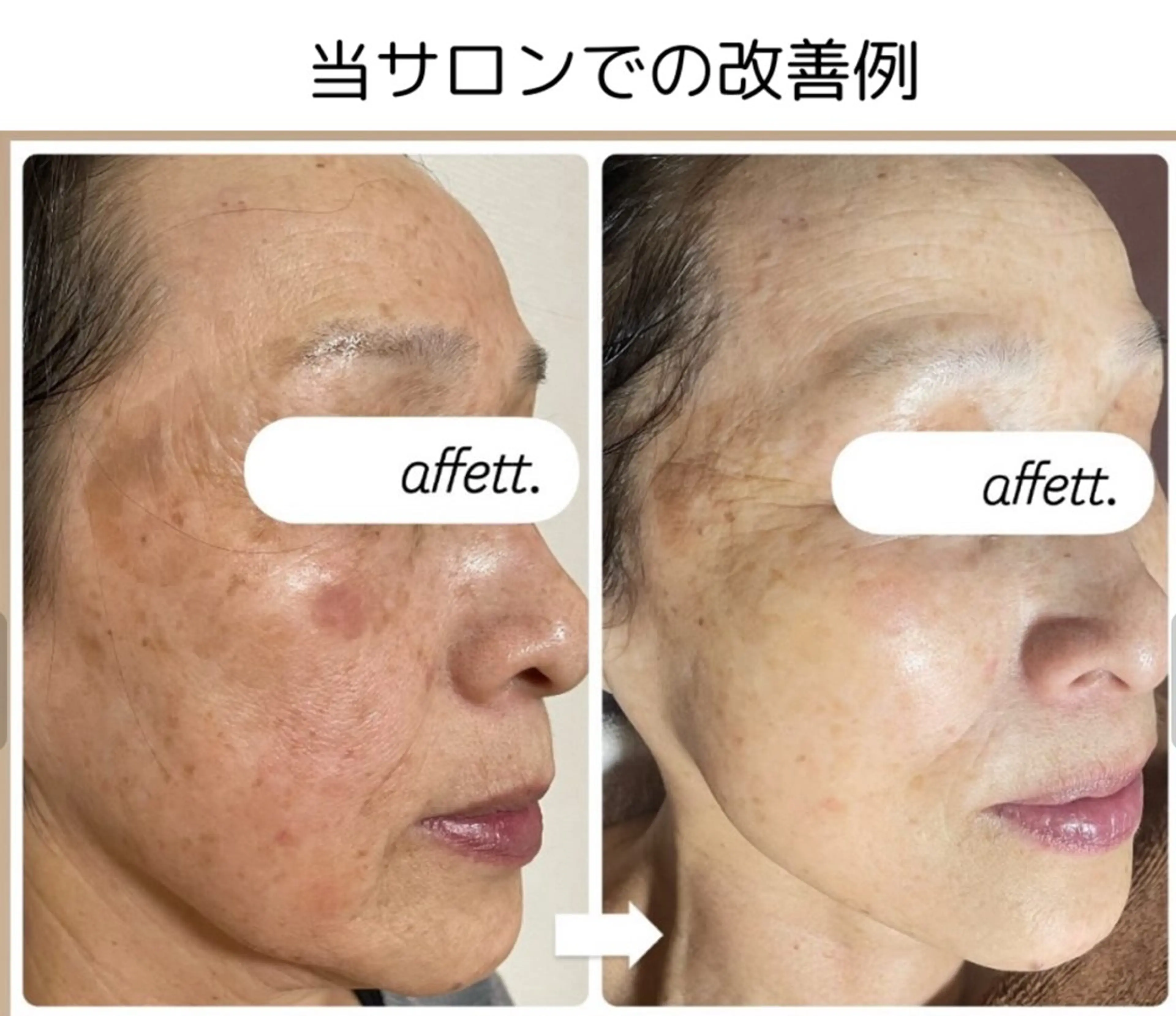 エステ 肌質改善&アロマサロンaffett.所属・澤井 千晴のエステ・リラクイメージ