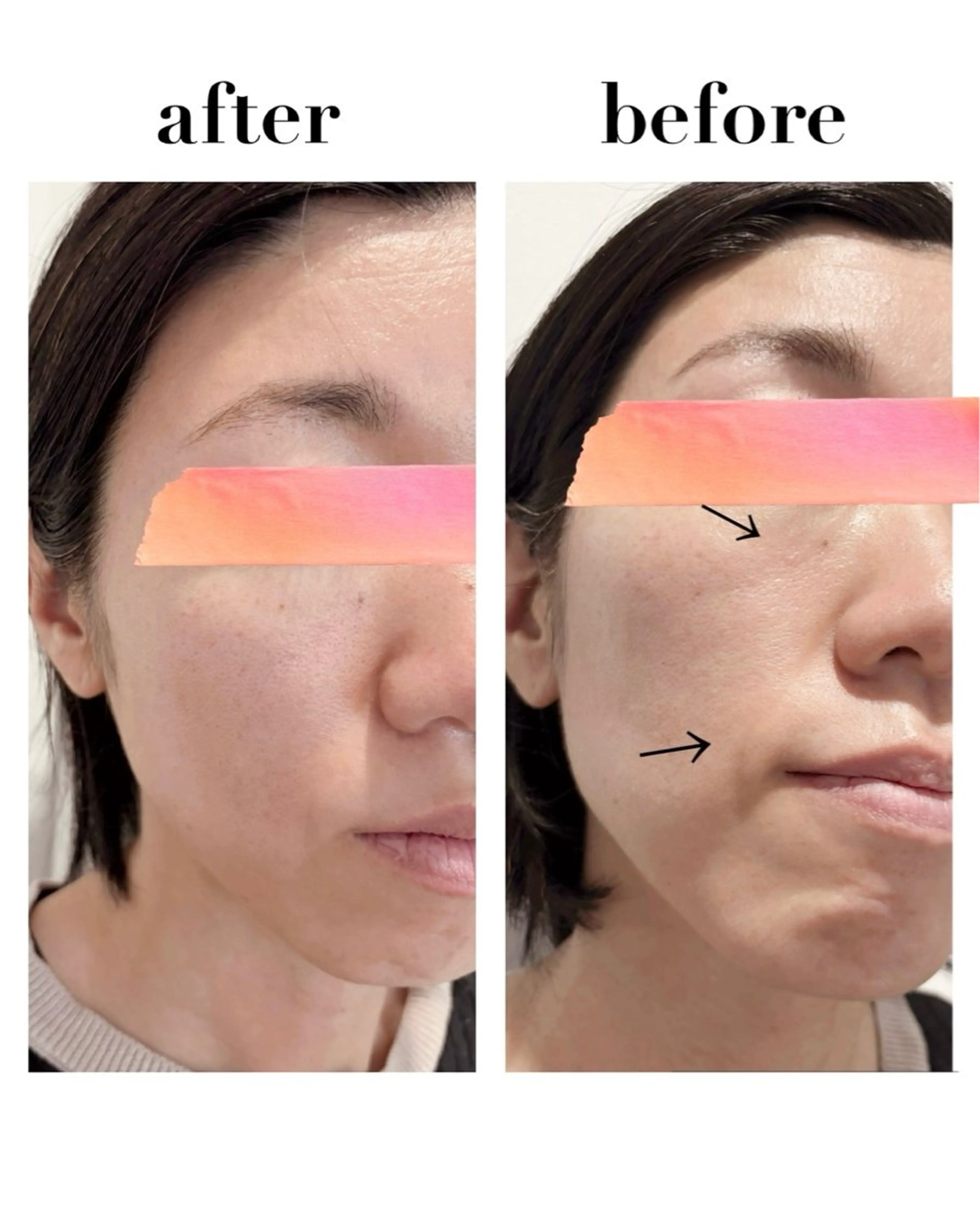 【ミニモ学割】ニキビ肌・毛穴・くすみ改善✨フェイスラインをスッキリさせたい方にもオススメ✨光フェイシャル✨2回体験の写真