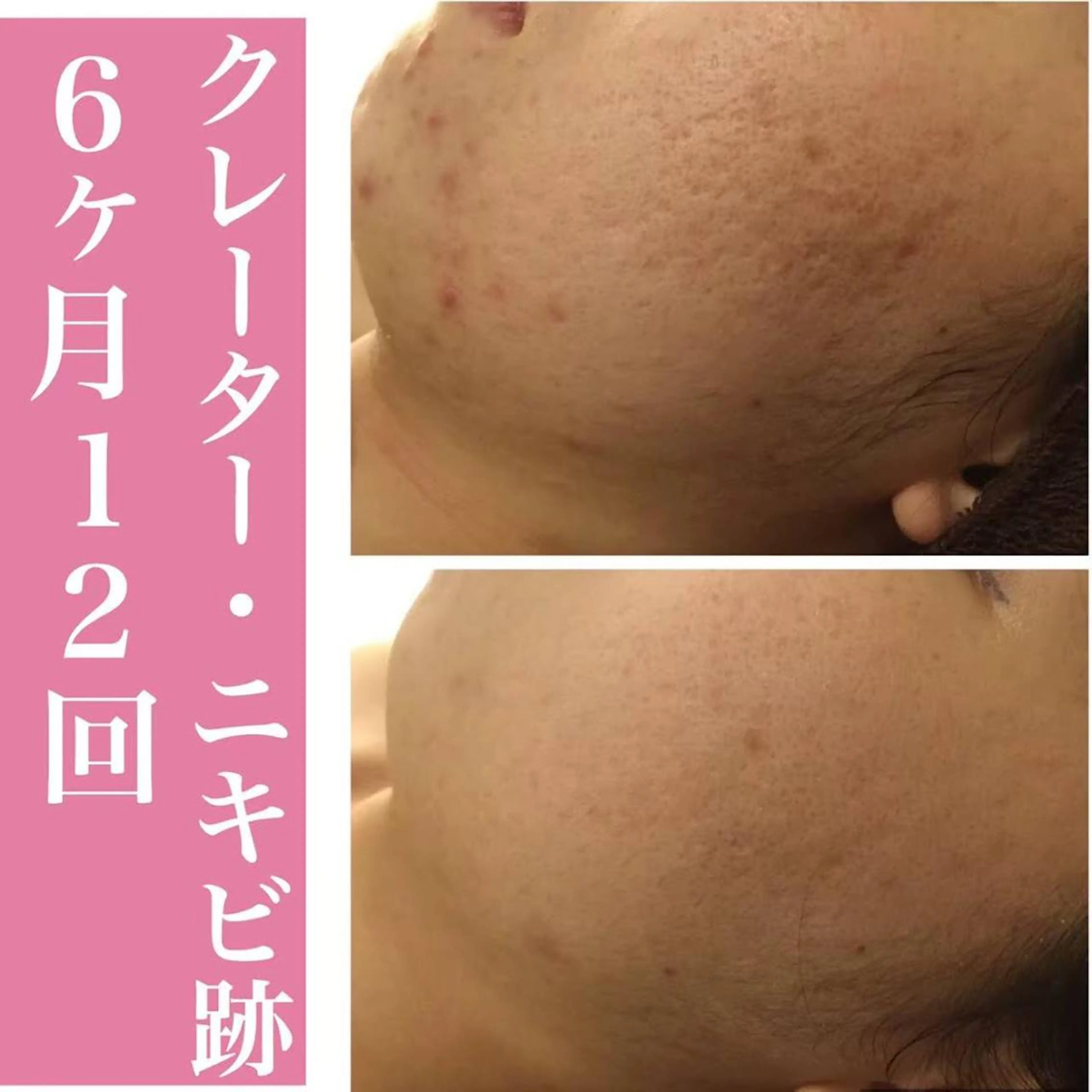 ロング カラー パーマ ヘアアレンジ メンズ キッズ ネイル マツエク・マツパ 都内で出来る肌管理！ 最短ニキビ改善のエステ・リラクイメージ