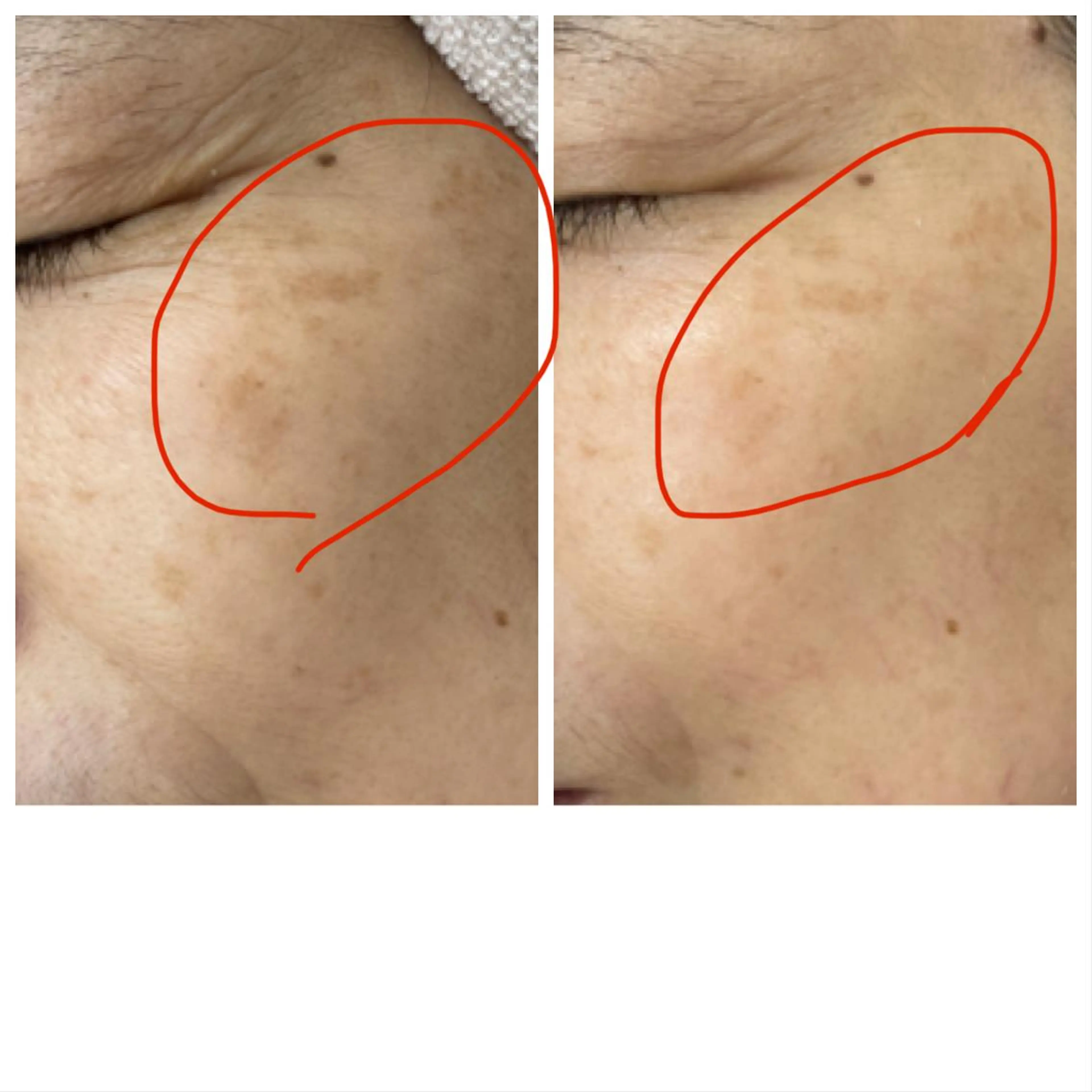 『シミ・シワ』お悩み別の肌質改善&メイクで至福の90分。初回のみ120分。通常¥8800→¥6600ミニモ特別価格です。の写真