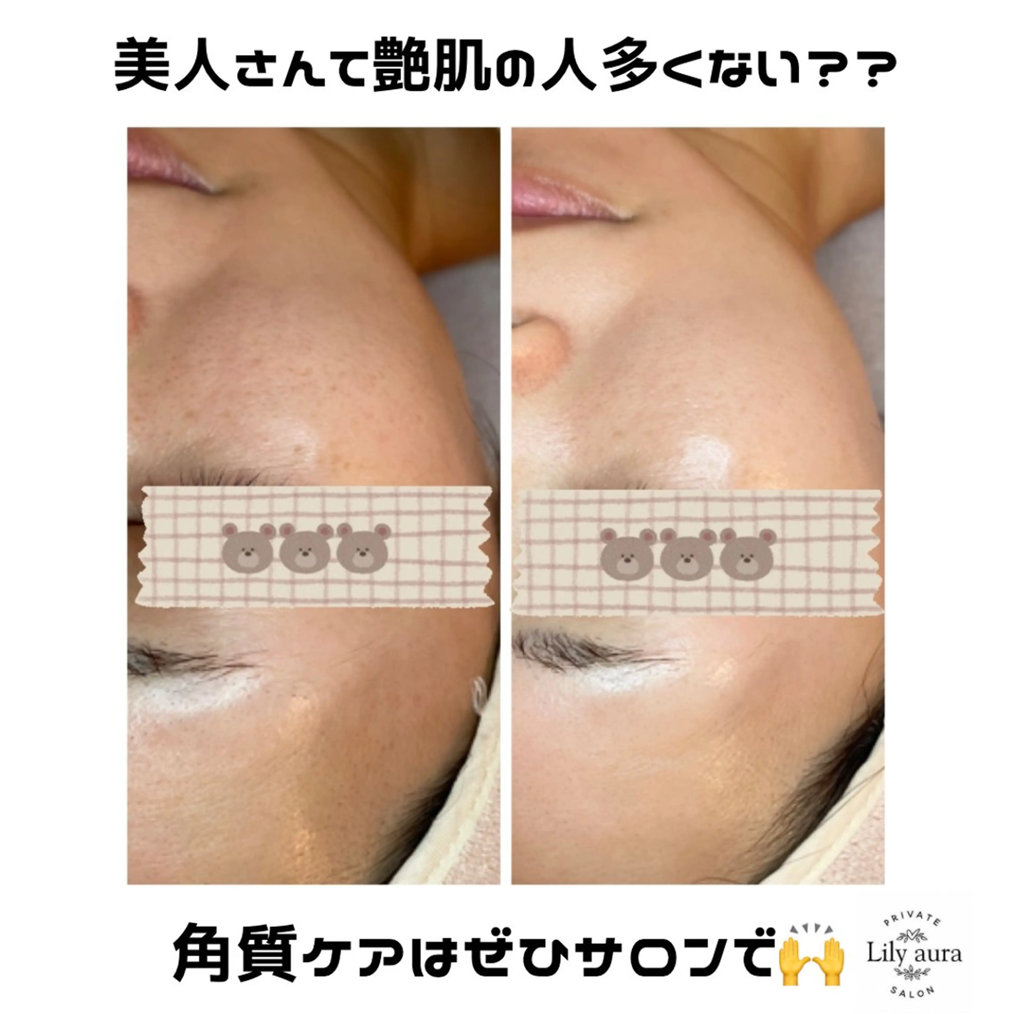 ニキビ/敏感肌/乾燥 Lilyauraのエステ・リラクイメージ
