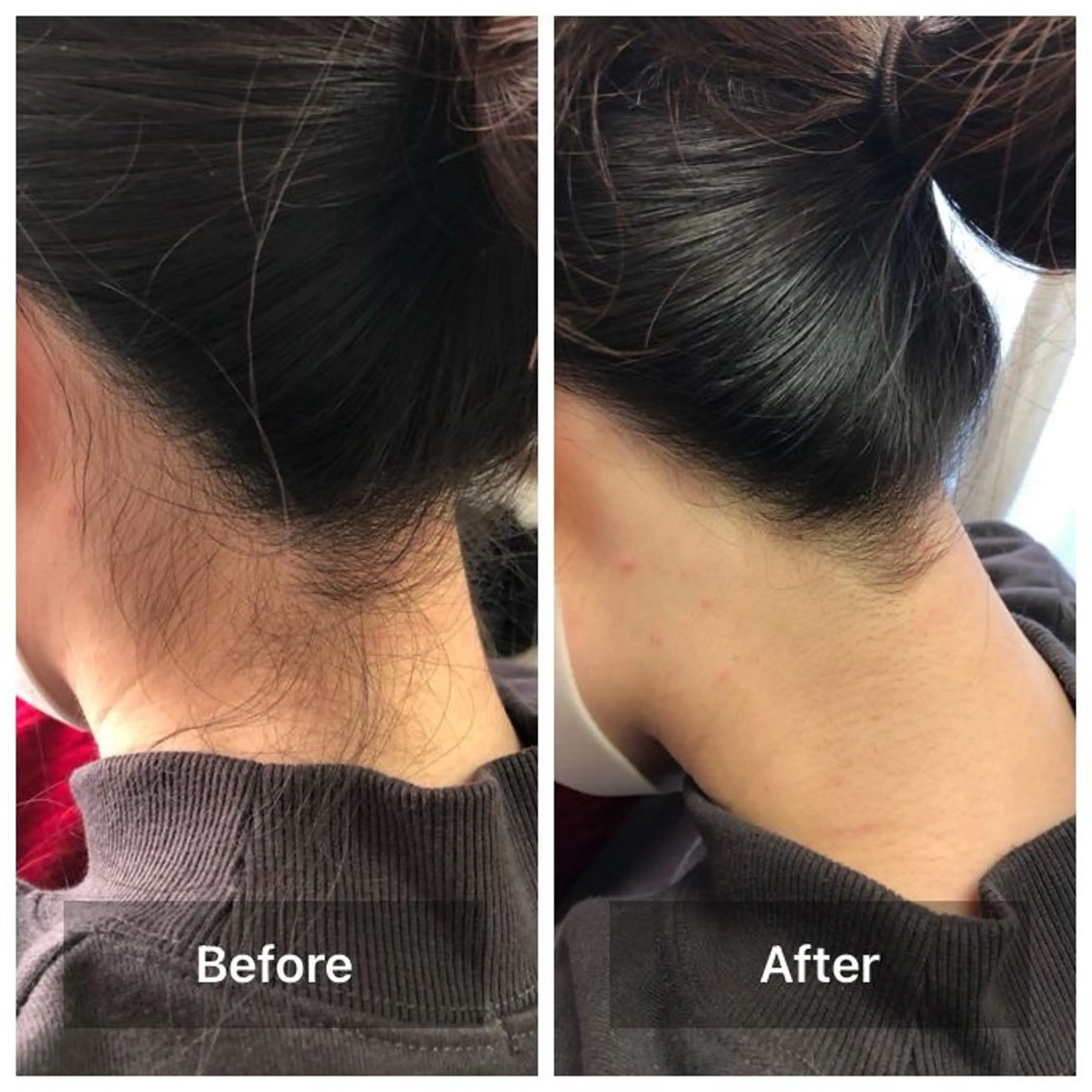 脱毛 smileskin 御薗橋／meguのその他イメージ