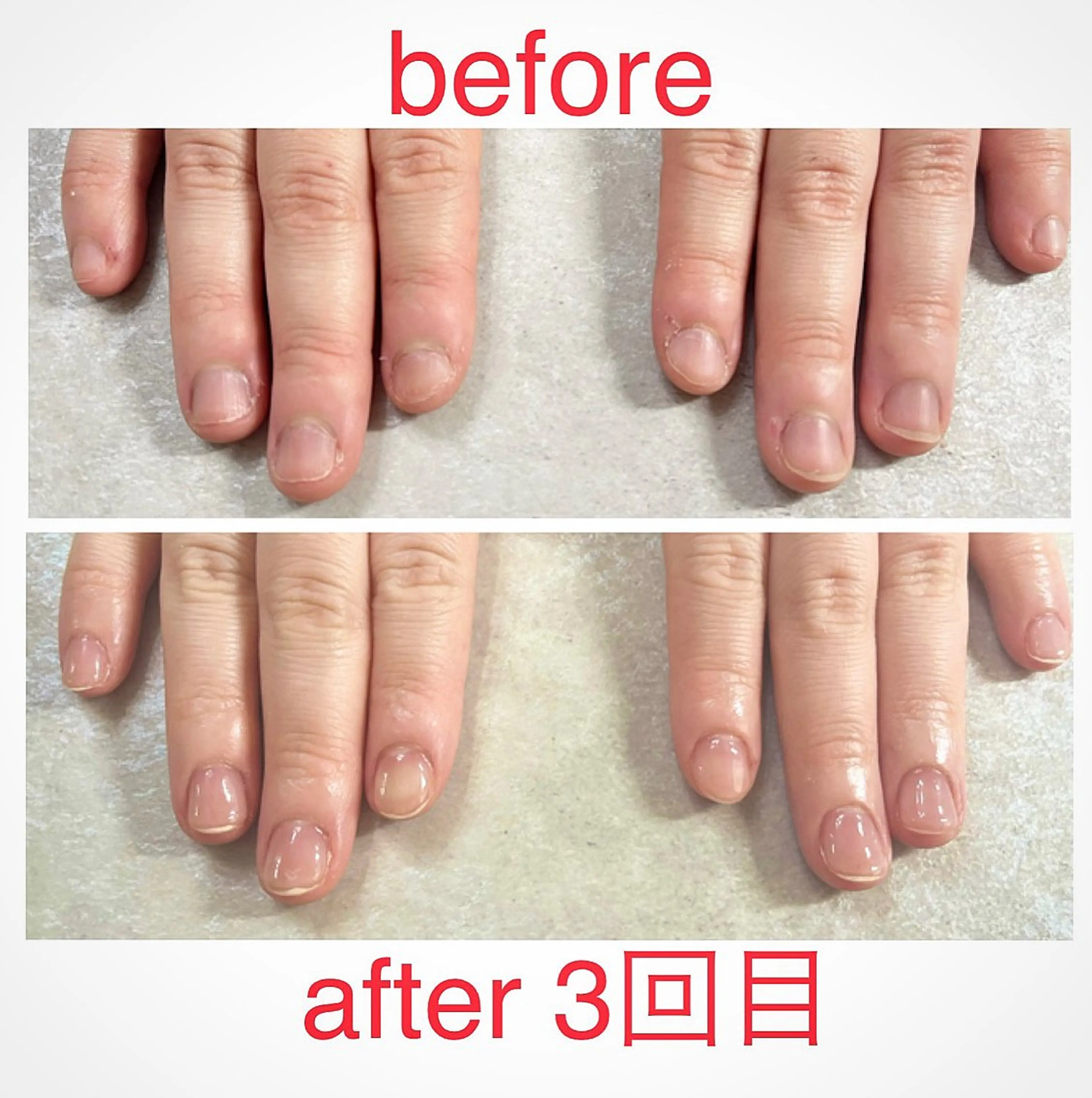 美爪ケア⭐︎育爪⭐︎クリアジェルモデル様募集　自爪が短い方、深爪の方、噛み癖のある方など⭐︎３回施術してくださる方募集の写真