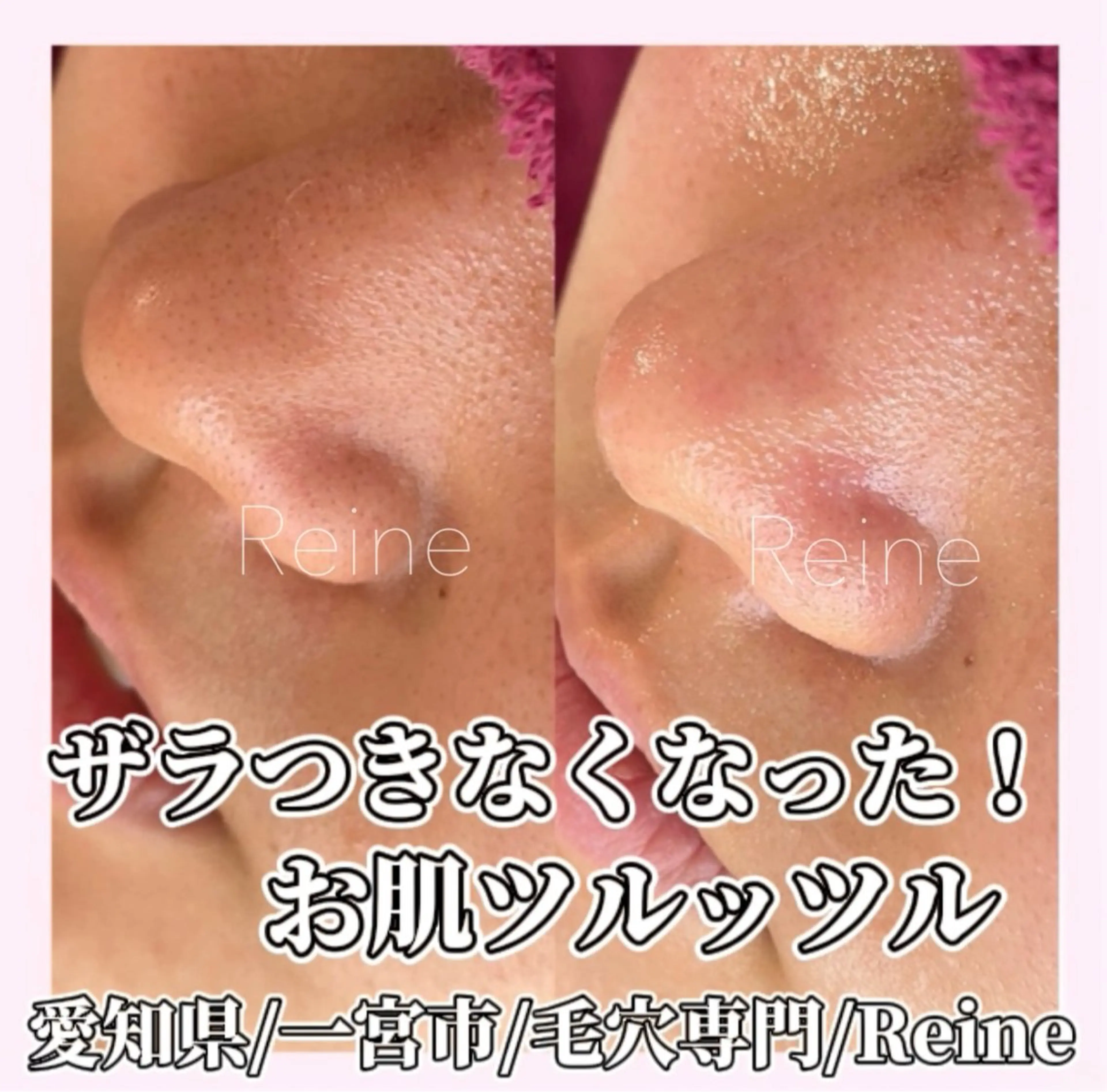 エステ Reine BeautySalon所属・毛穴/シミ肝斑/脱毛 横山梨里のエステ・リラクイメージ