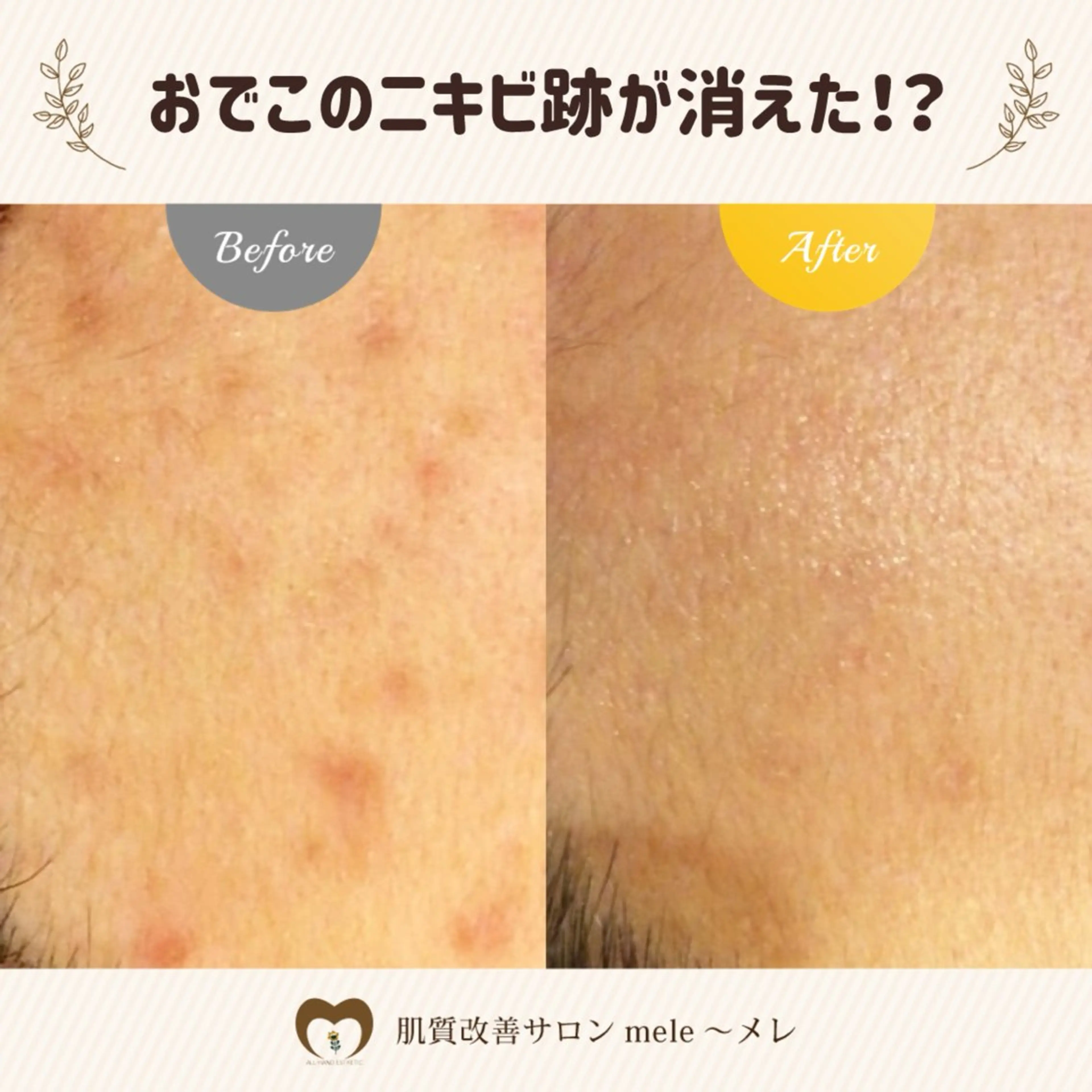 ニキビケア/毛穴/ 赤み/自信の肌✨森園のエステ・リラクイメージ