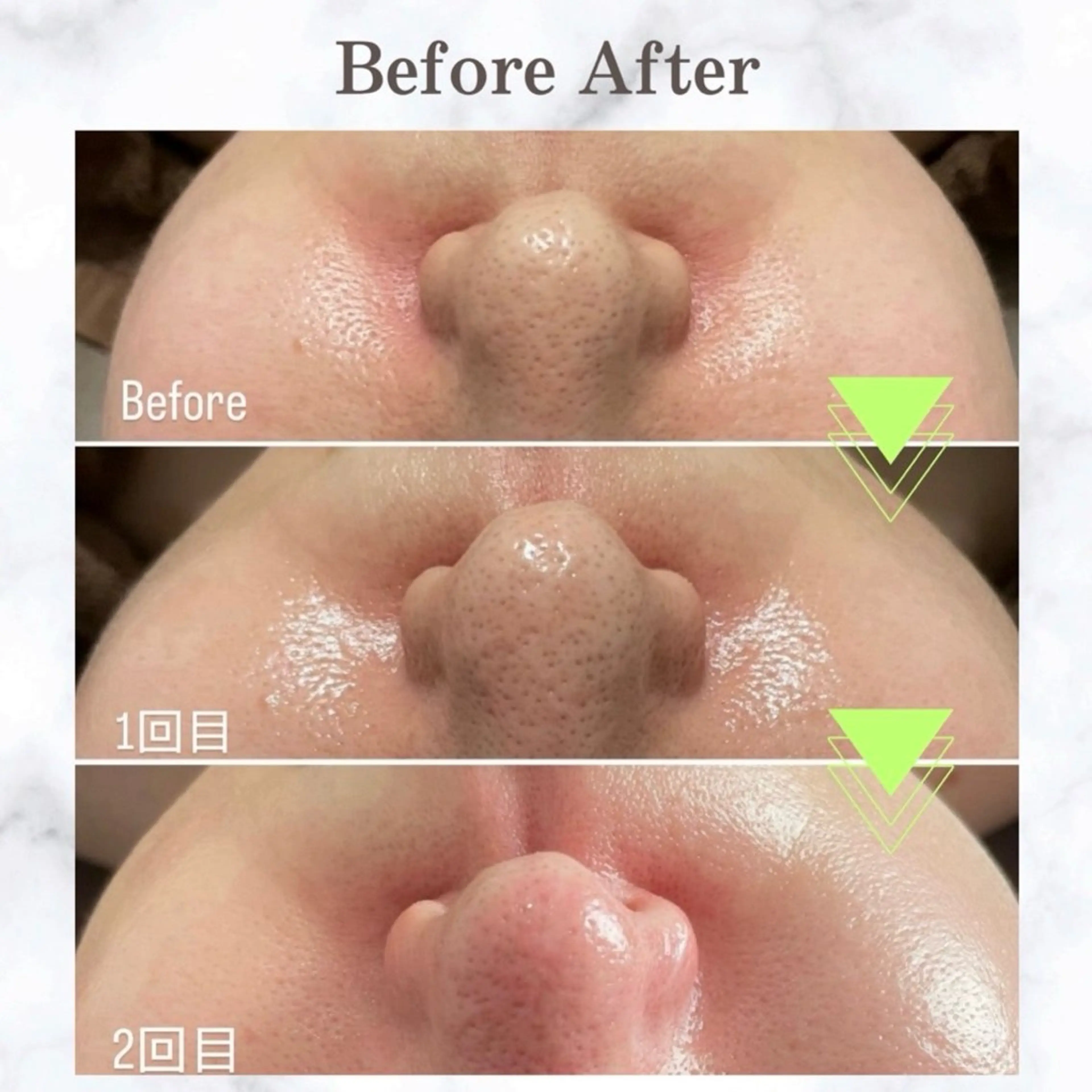 韓国式美肌毛穴洗浄🇰🇷✨【鼻のみ】の写真