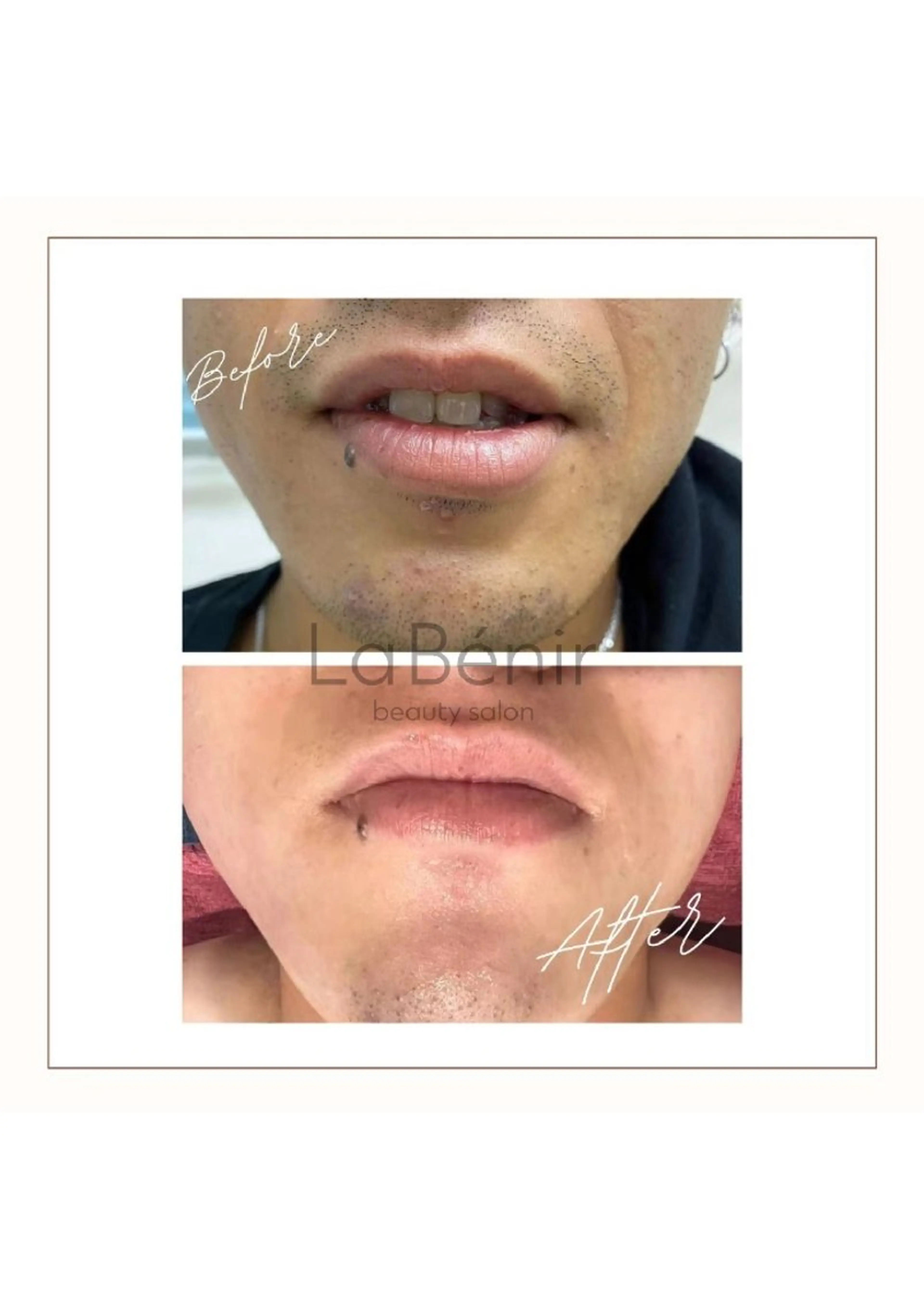 メンズ エステ 脱毛/美肌【皮膚科看 護師経営】ラベニールのエステ・リラクイメージ