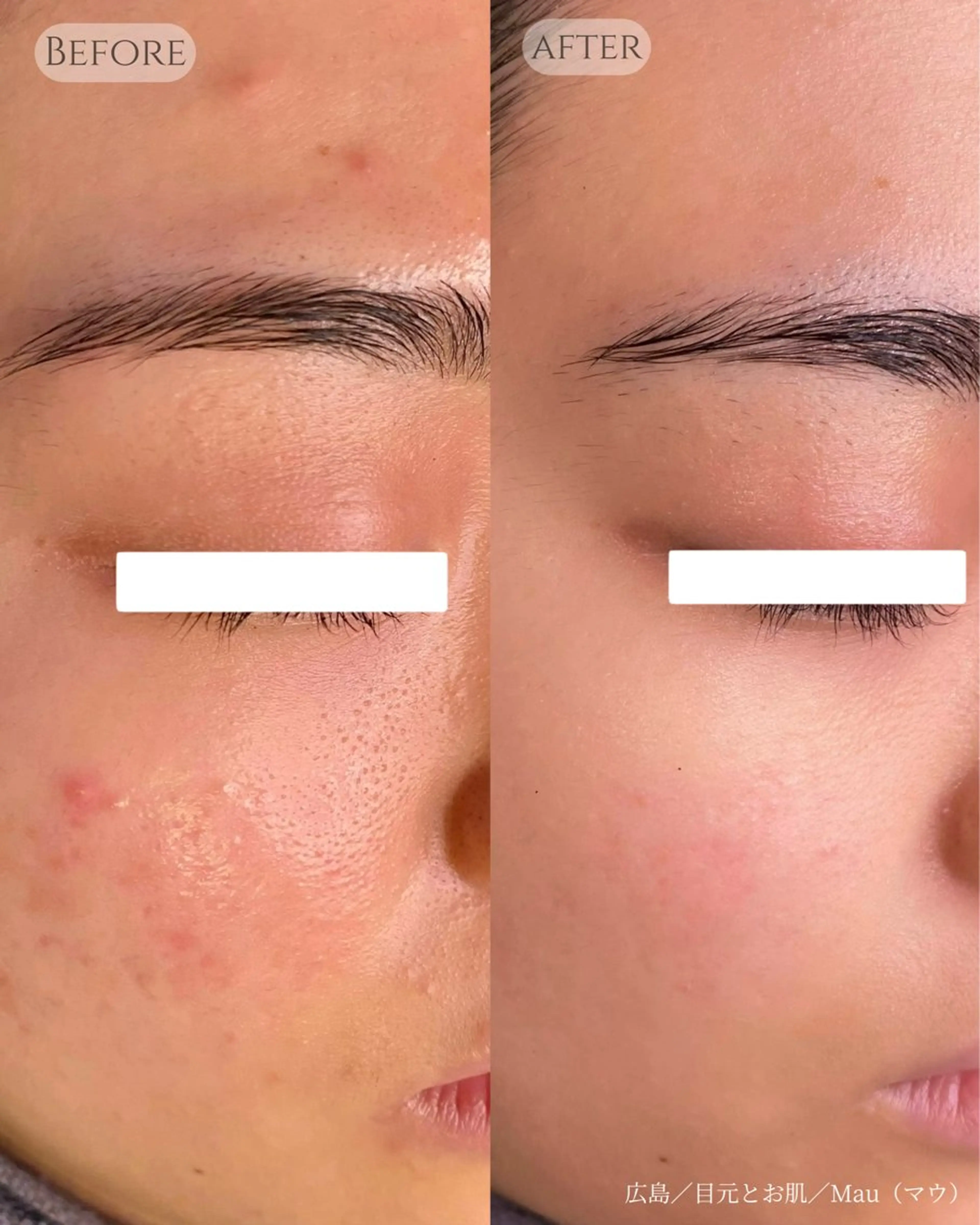 【毛穴・ニキビケア】-毛穴引き締めとお肌に優しいハーブピーリングで健康的な艶肌に🌿剥離せず、ダウンタイムもありませんの写真