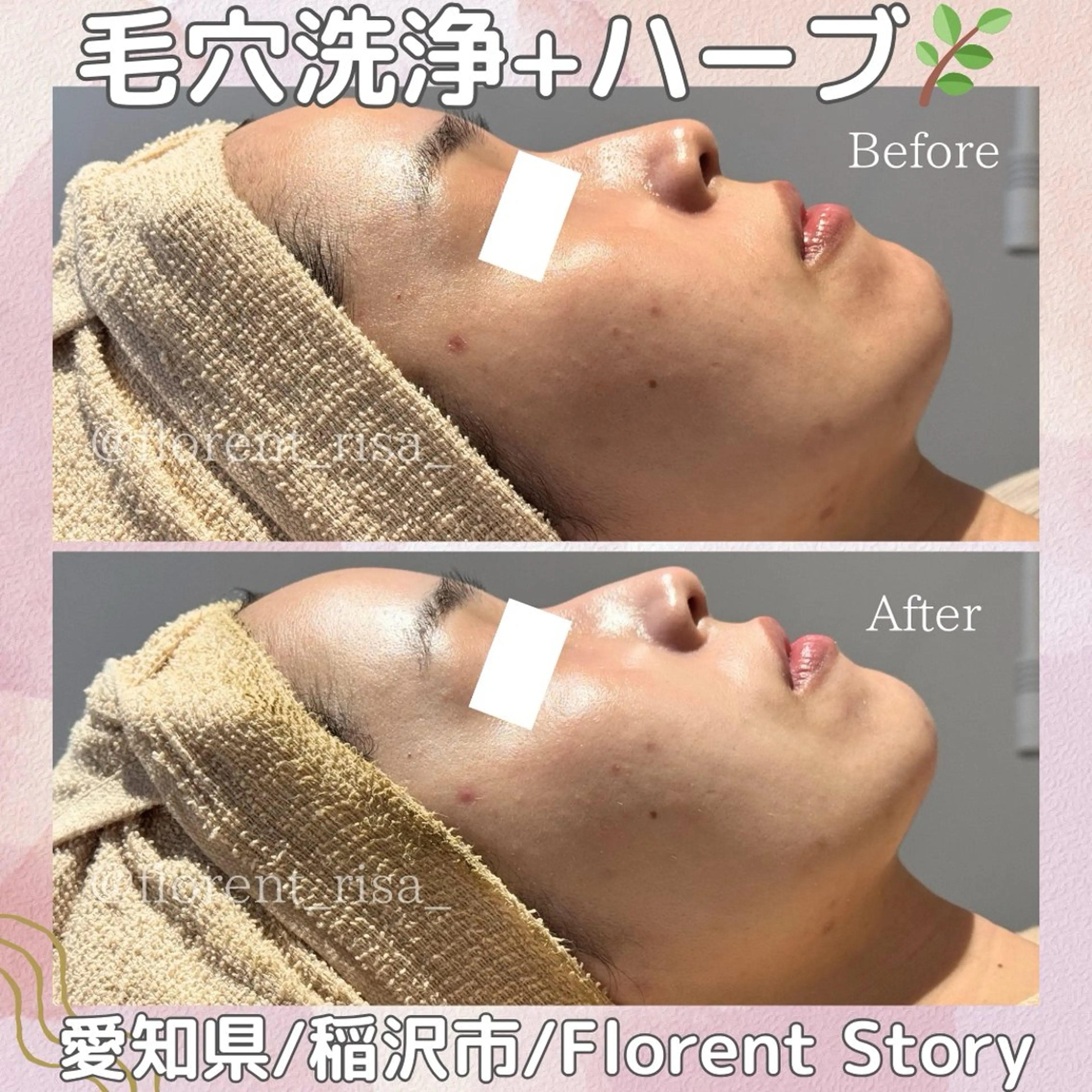 首までたっぷり☆次世代ハーブピーリング(顔+首)の写真