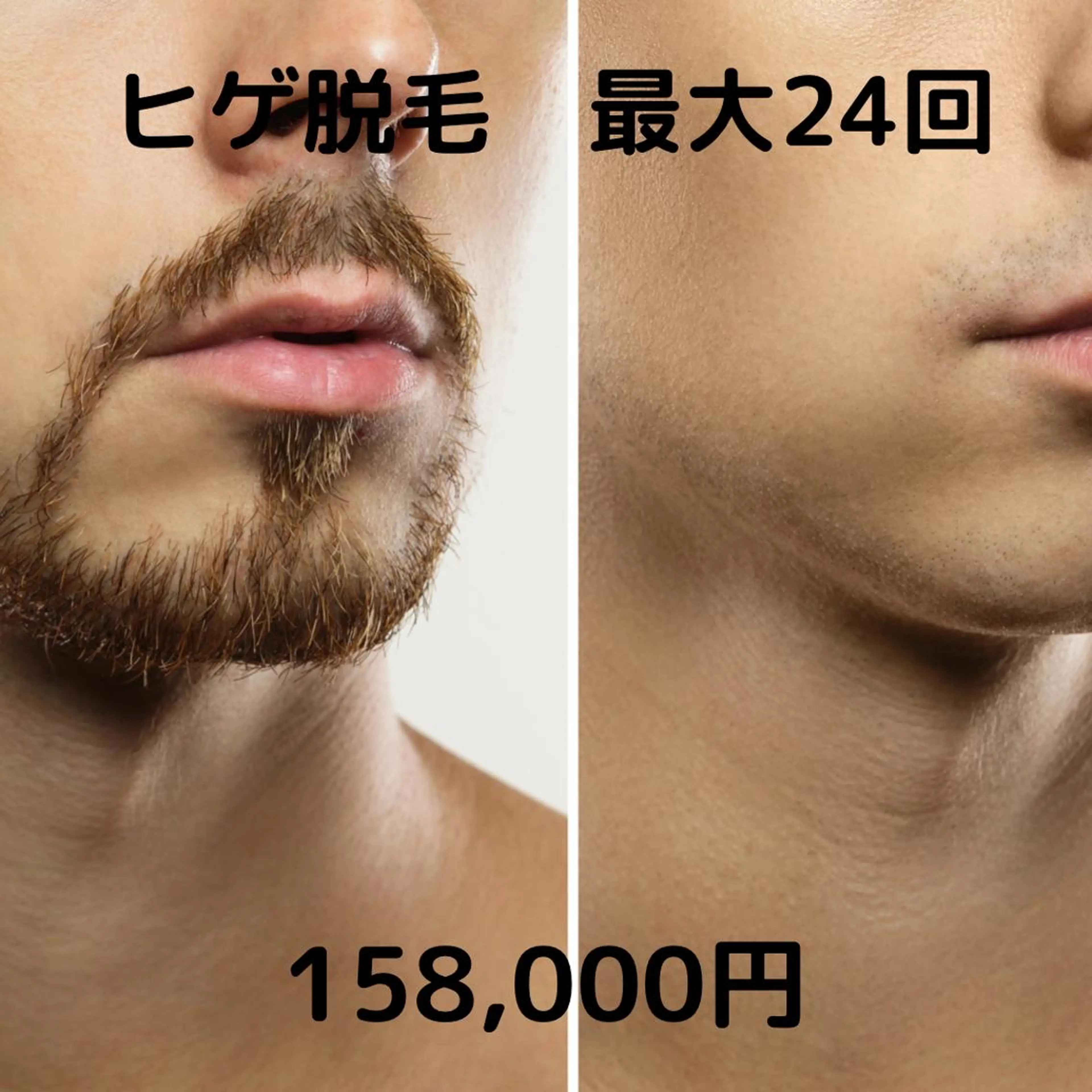 【−20℃快適♪ヒゲ脱毛】1年通い放題　まるっと全部ひげ脱毛　最大24回！効果◎青ヒゲ根絶宣言！！の写真