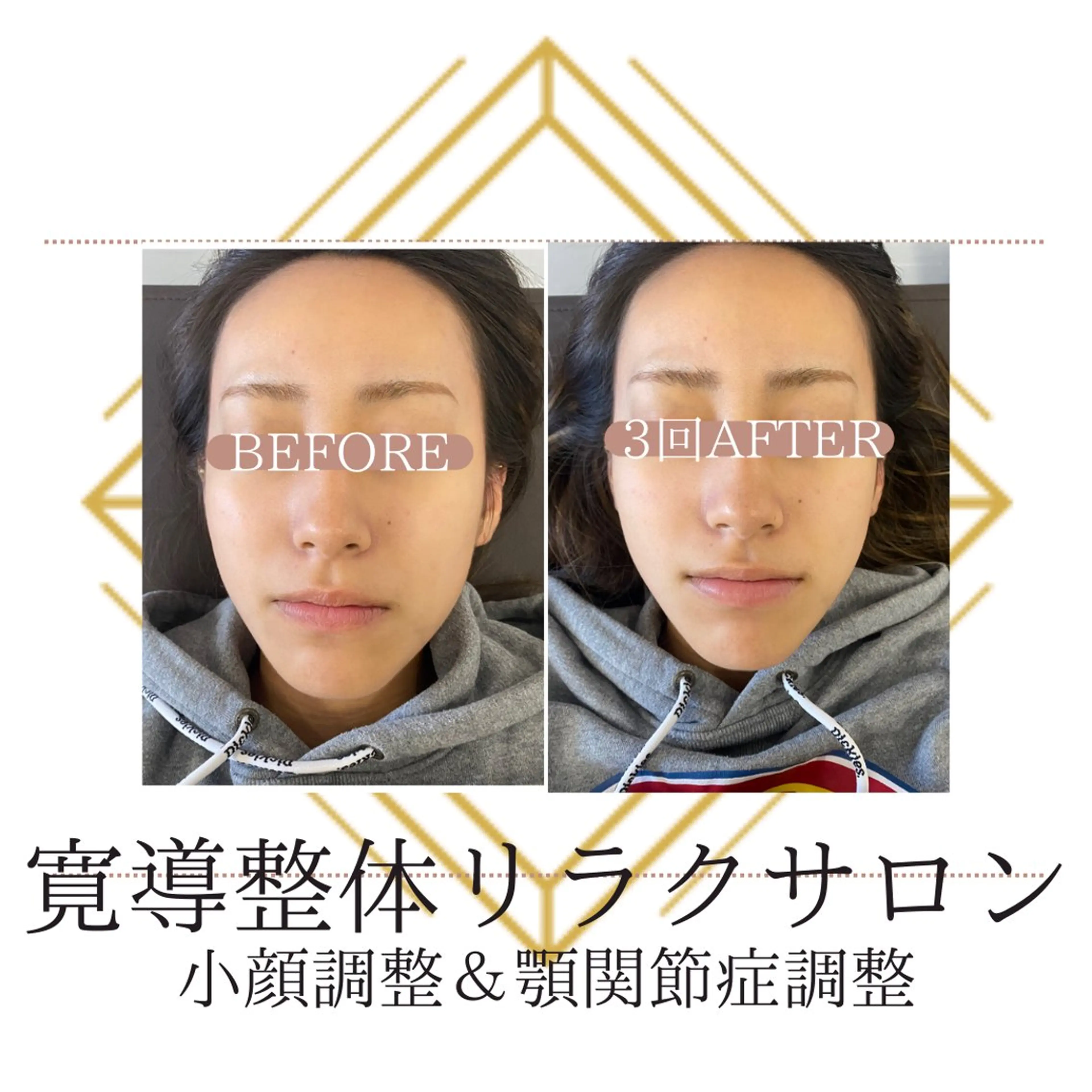 大人気！小顔調整♪全8回¥20,000の写真