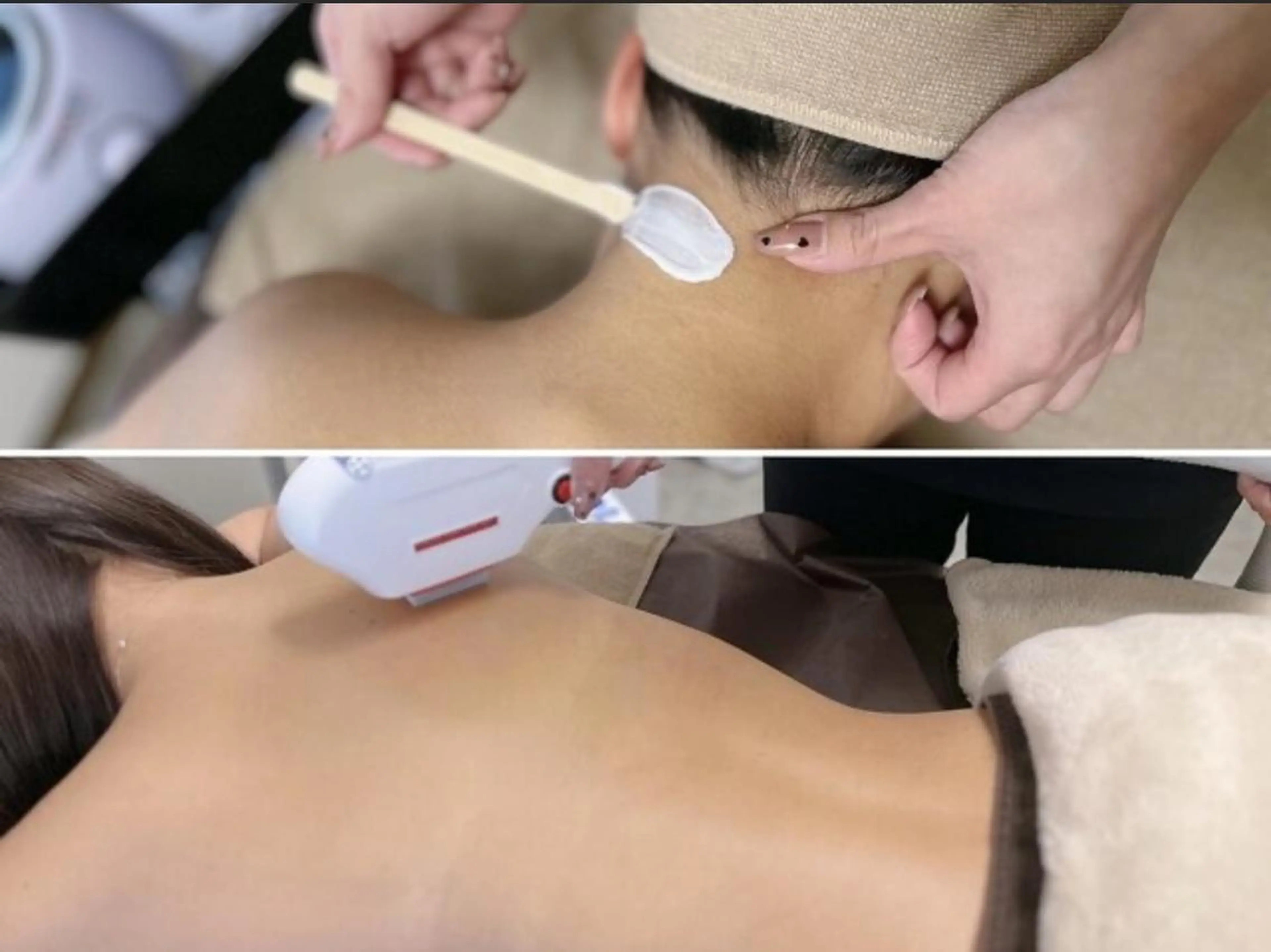 【うなじMIX+背中光脱毛】卒業式、結婚式前に後ろ姿美人へ✨¥7900の写真