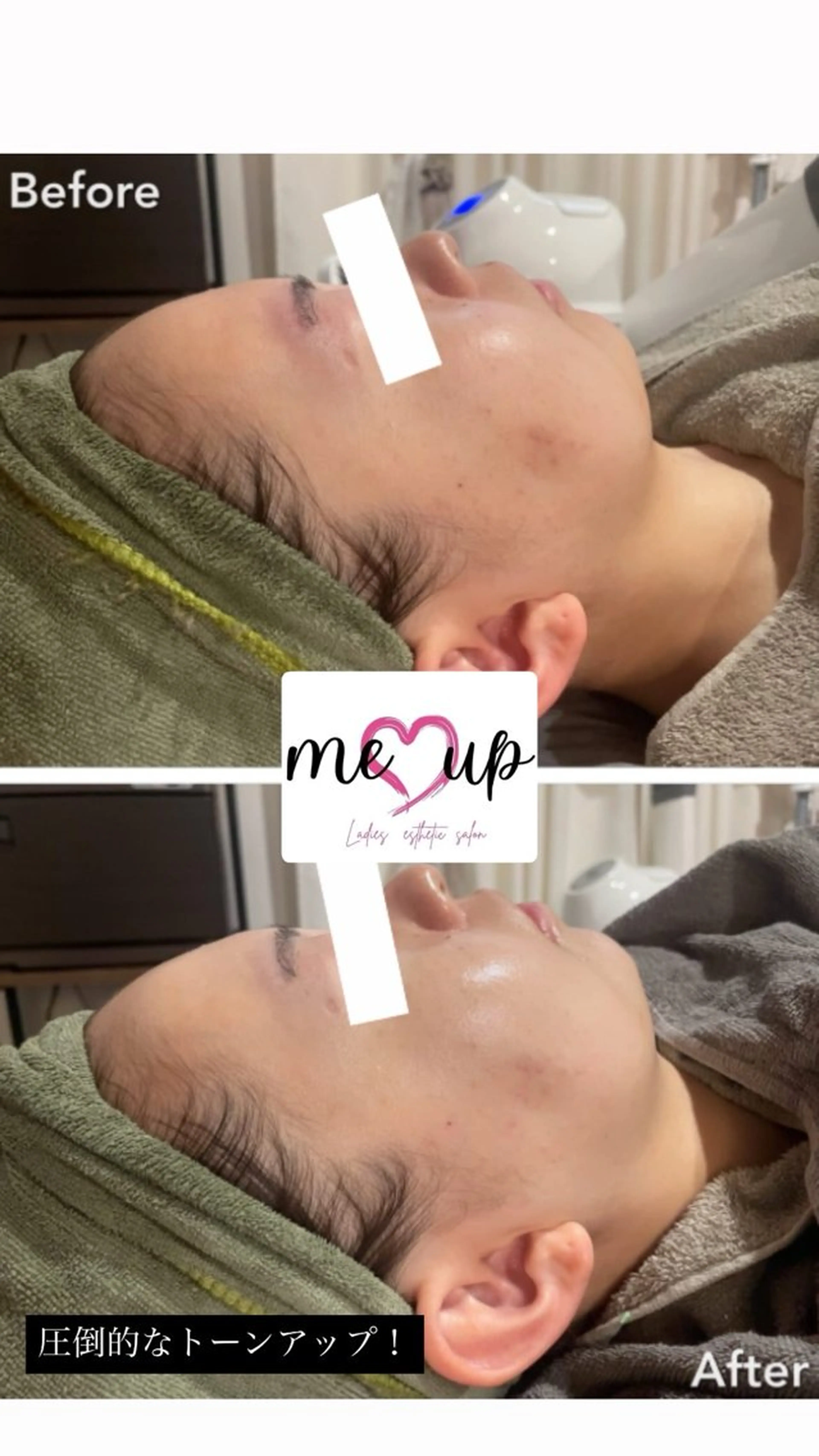 エステ Meupニキビ専門店 背中/ハーブ/肌管理のその他イメージ