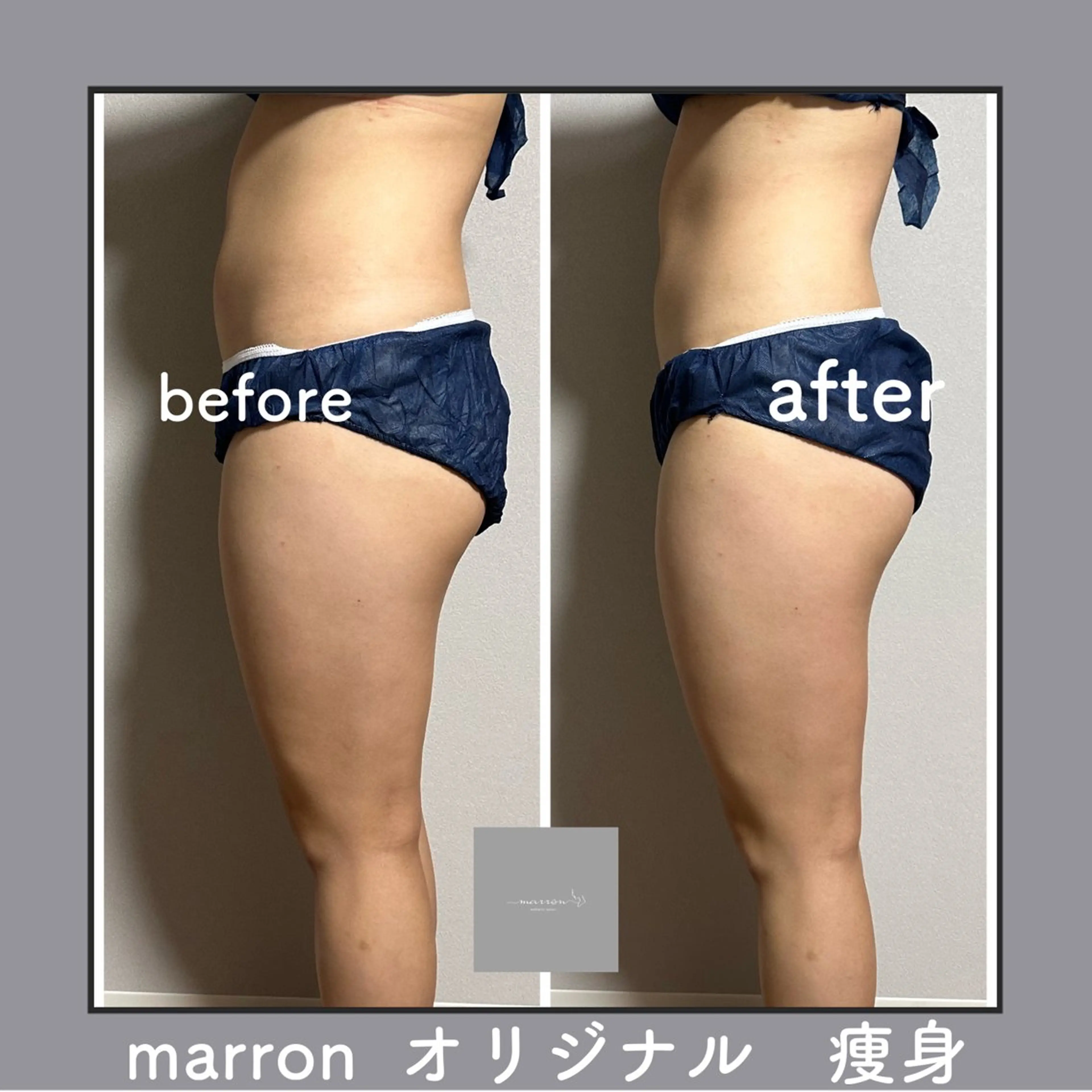 marron所属・痩身ハイパーナイフ ララピールリアボーテのエステ・リラクイメージ