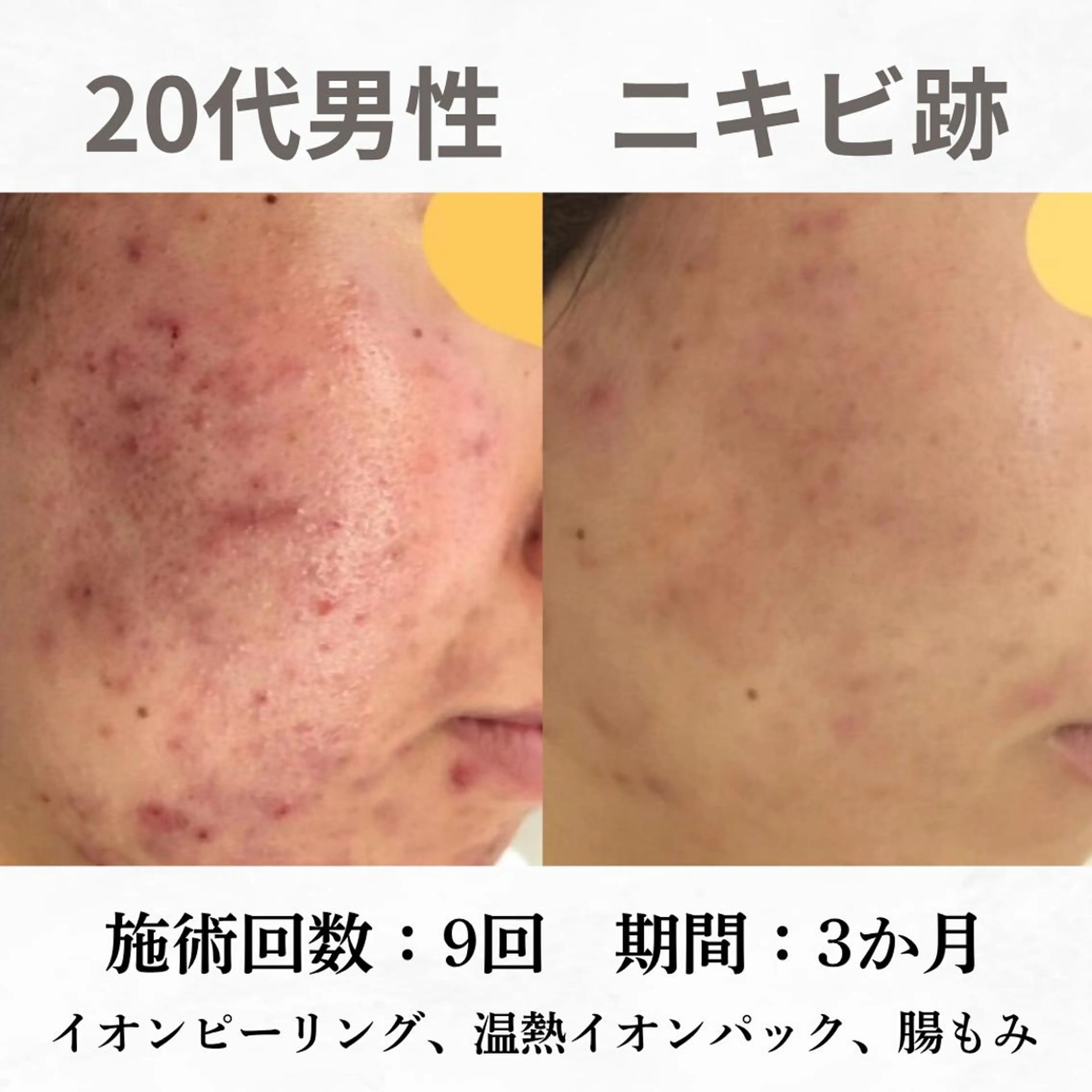 重度ニキビ専門🌷 ダウンタイムなしのエステ・リラクイメージ