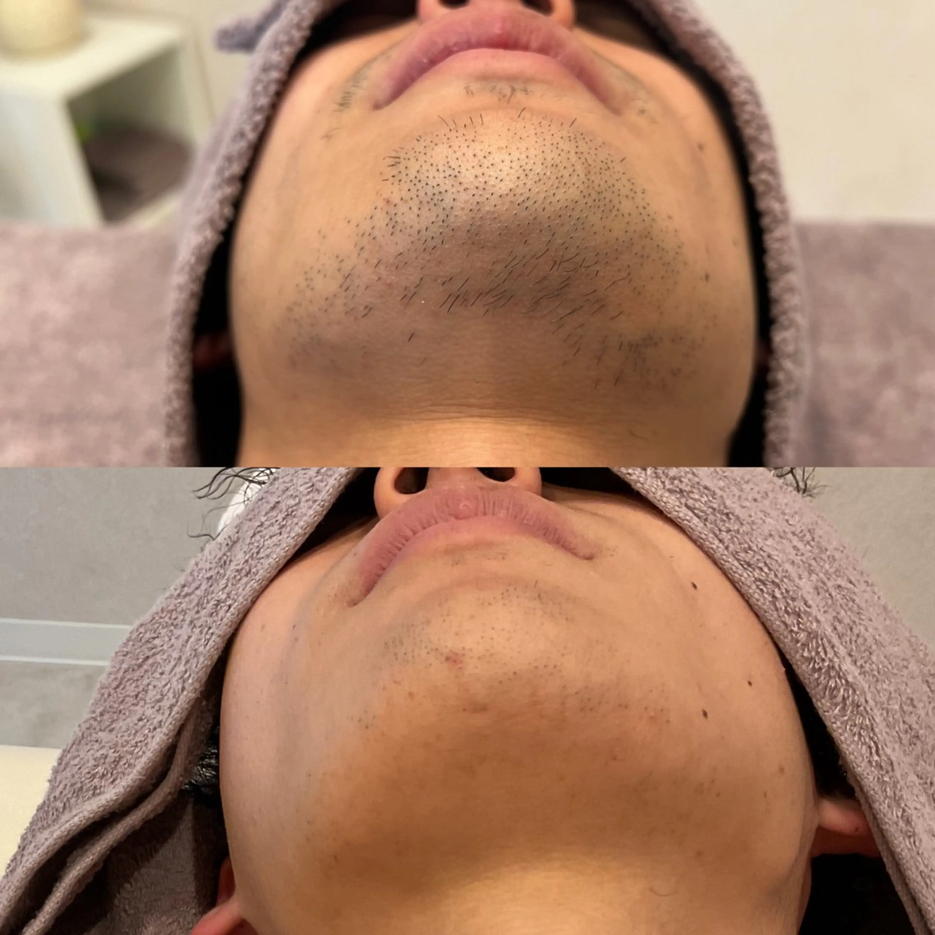 フェイシャルLED脱毛（男性の頑固なお髭にも✨）の写真