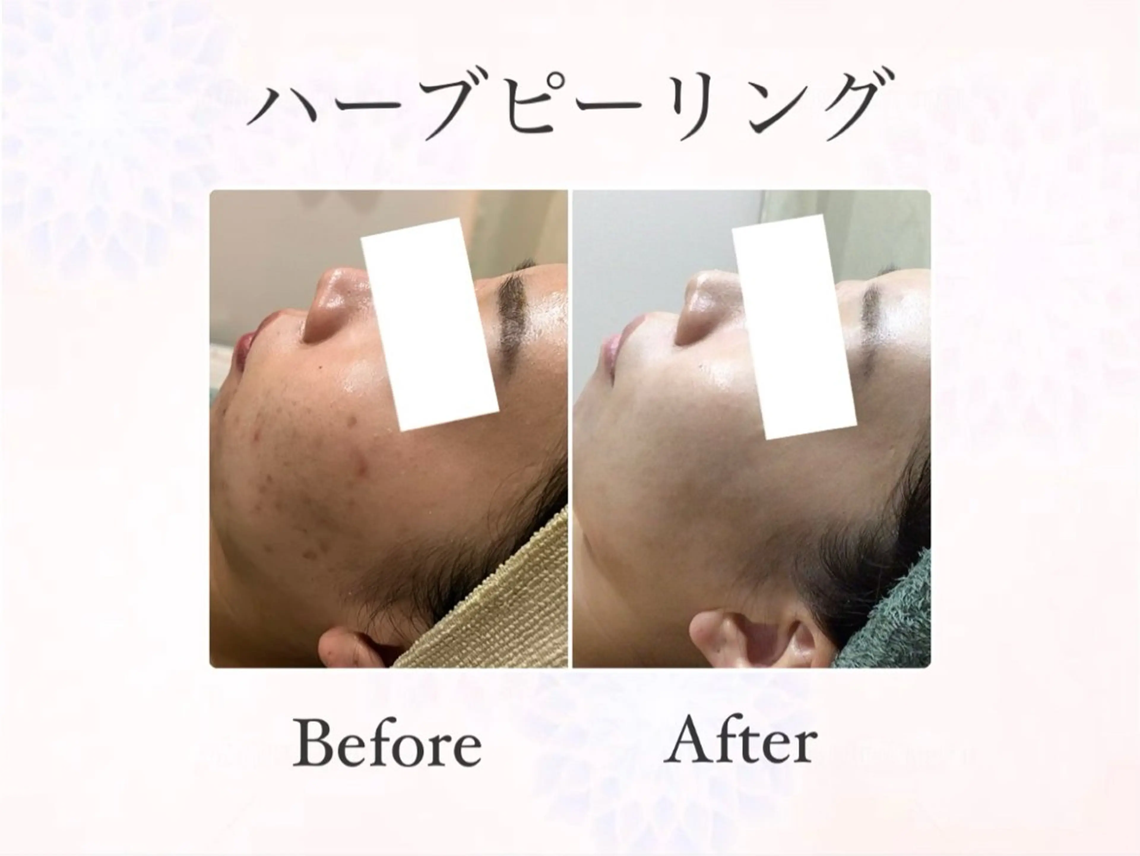 【ハーブピーリング&毛穴洗浄】大人気No.1🏆毛穴洗浄&剥離無しハーブピーリング🌿迷ったらコレ‼️の写真