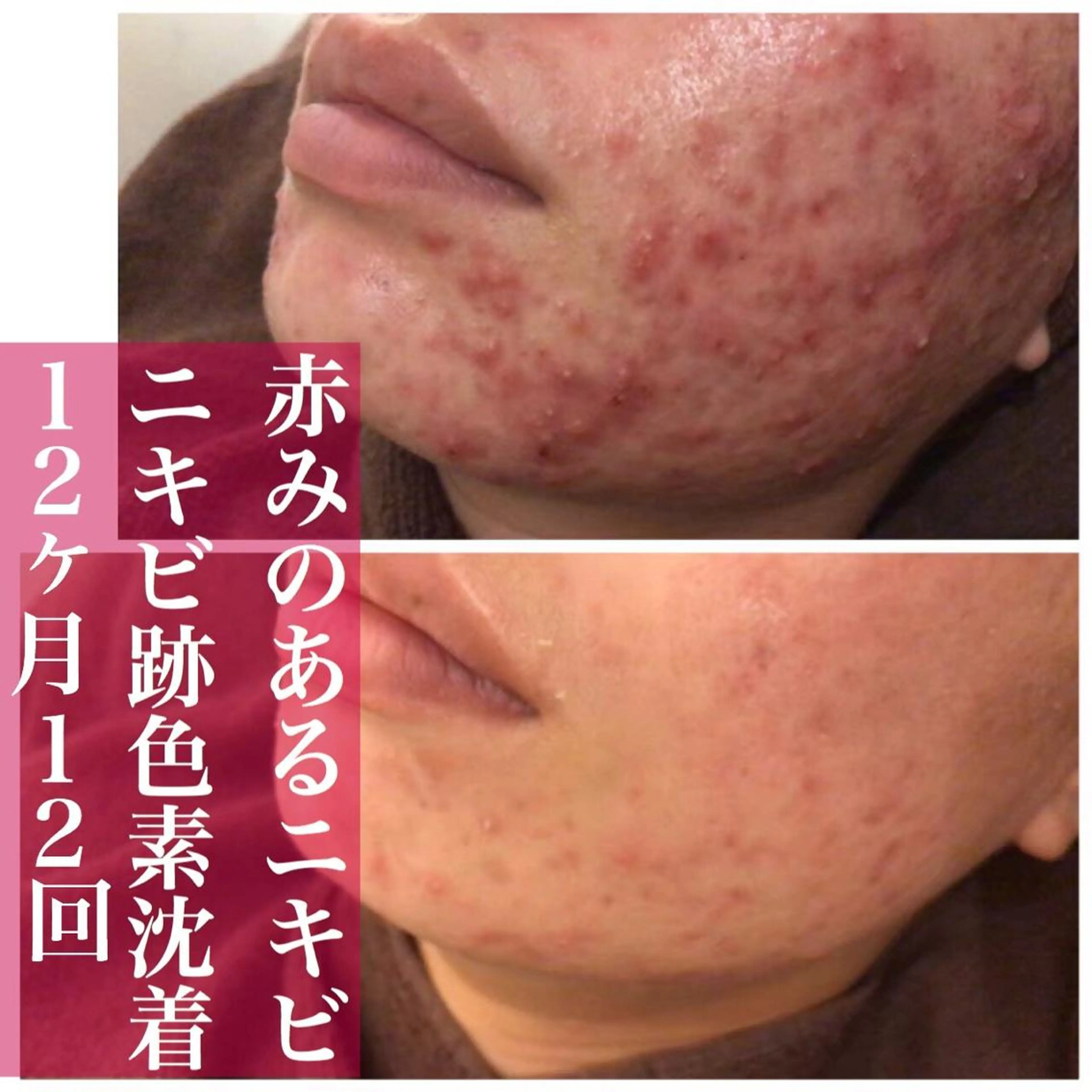 ミディアム カラー パーマ ヘアアレンジ メンズ キッズ ネイル マツエク・マツパ アイブロウ ニキビ・肌質改善専門 ♡人生が変わるサロンのエステ・リラクイメージ