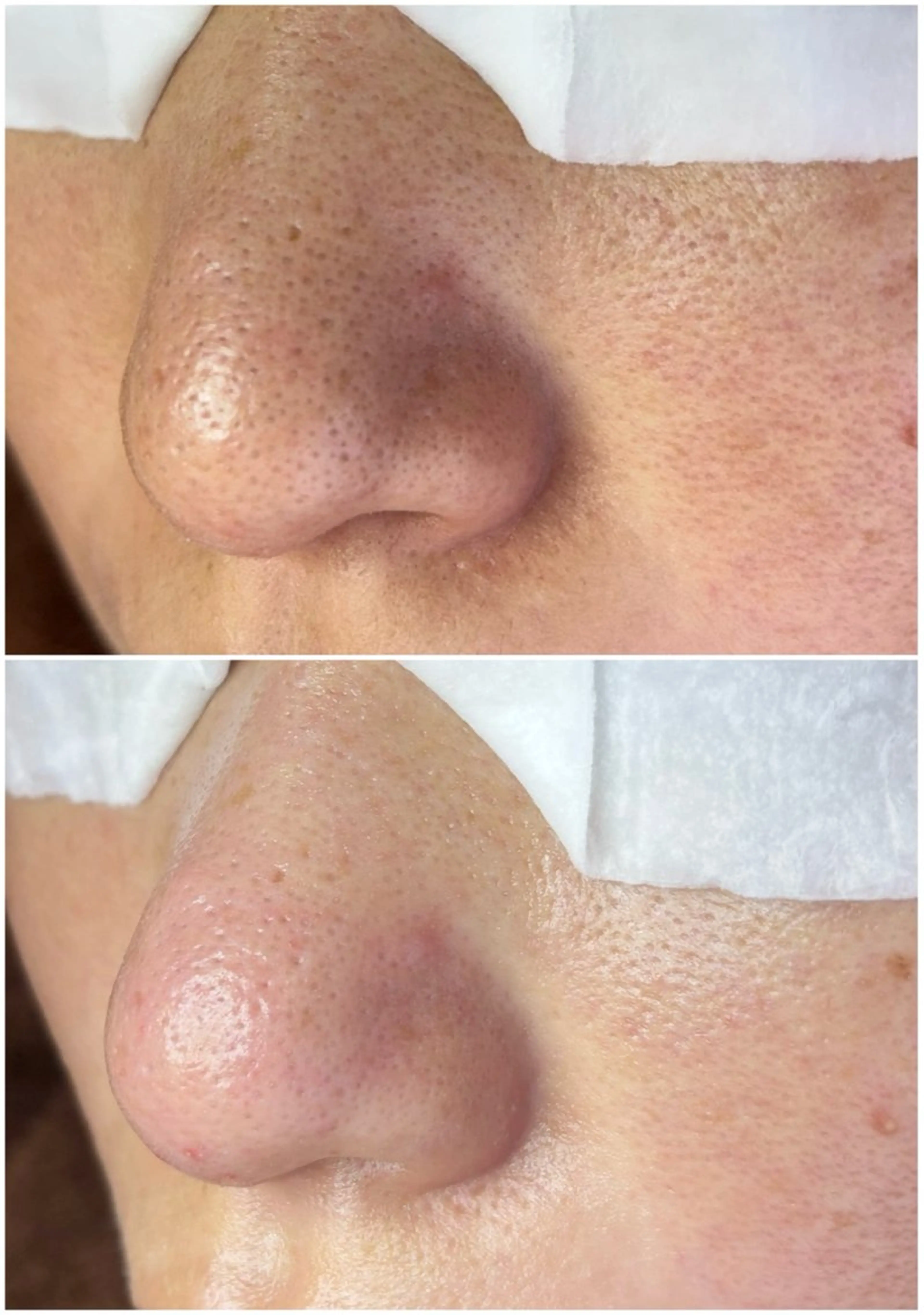 毛穴美人コース（ライト）の写真