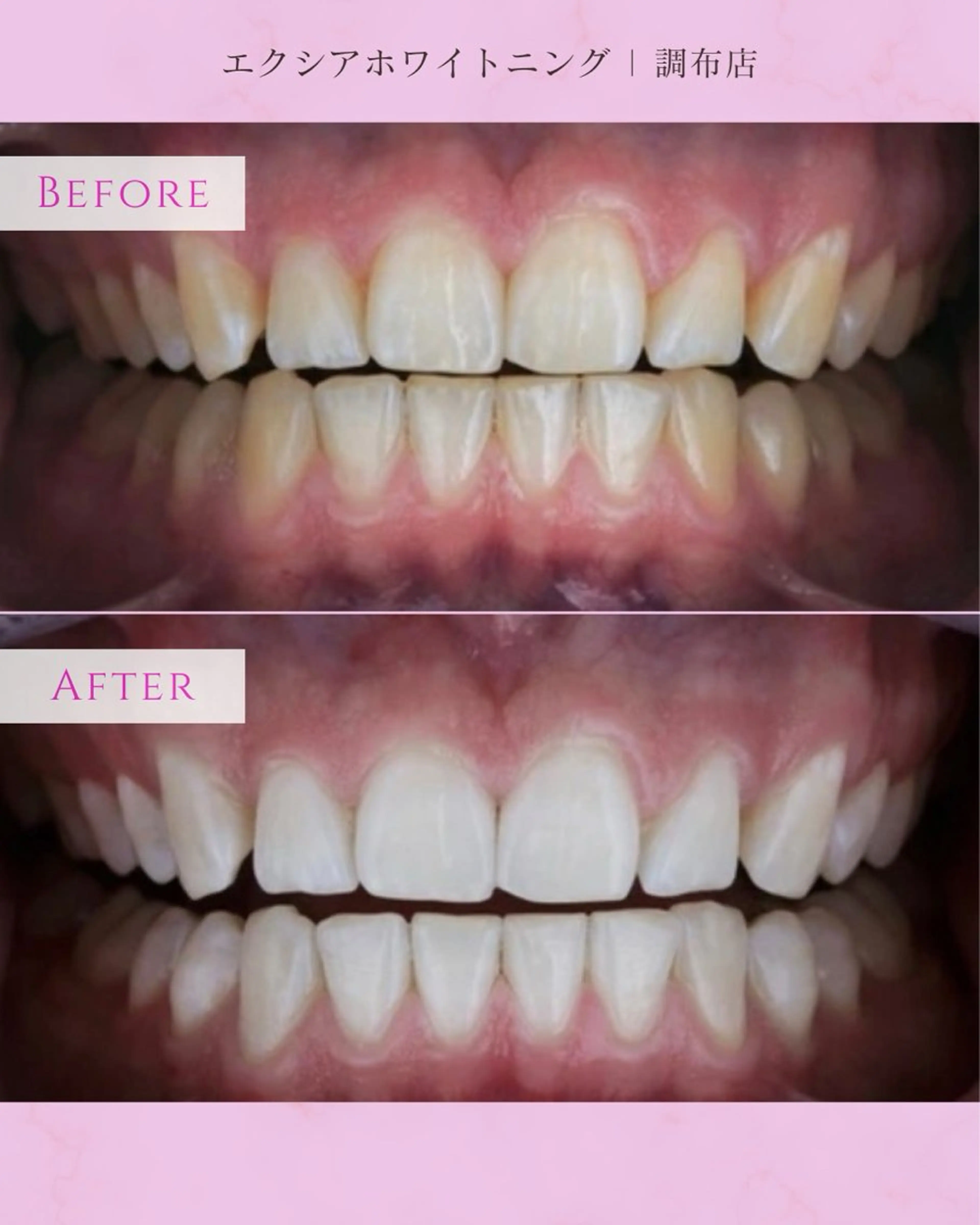 エクシアホワイト調布所属・umi❤︎ ホワイトニングのその他イメージ