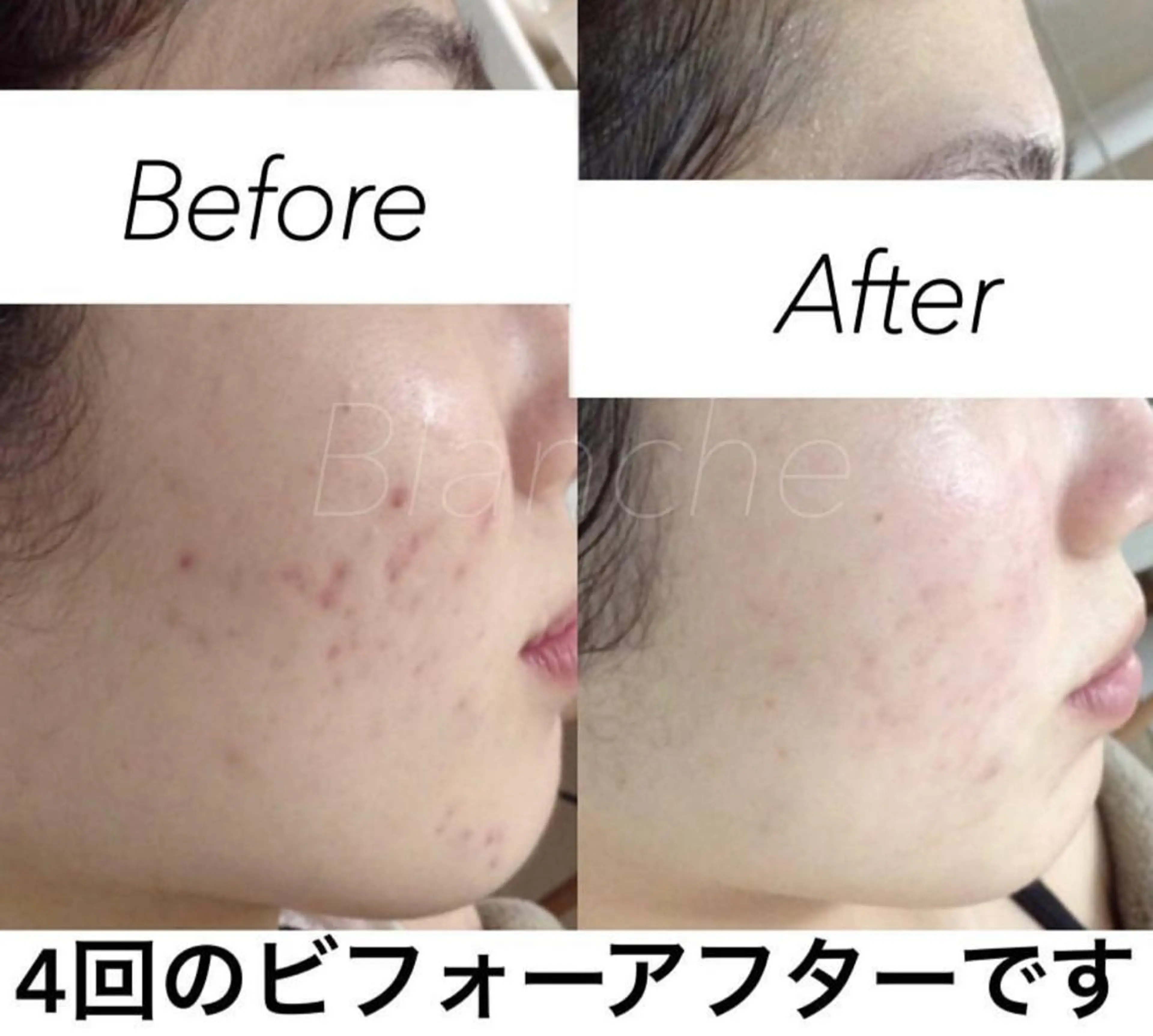 ショート カラー パーマ ヘアアレンジ キッズ ネイル マツエク・マツパ エステ リラク 都度払い肌質改善 &脱毛Blancheのエステ・リラクイメージ