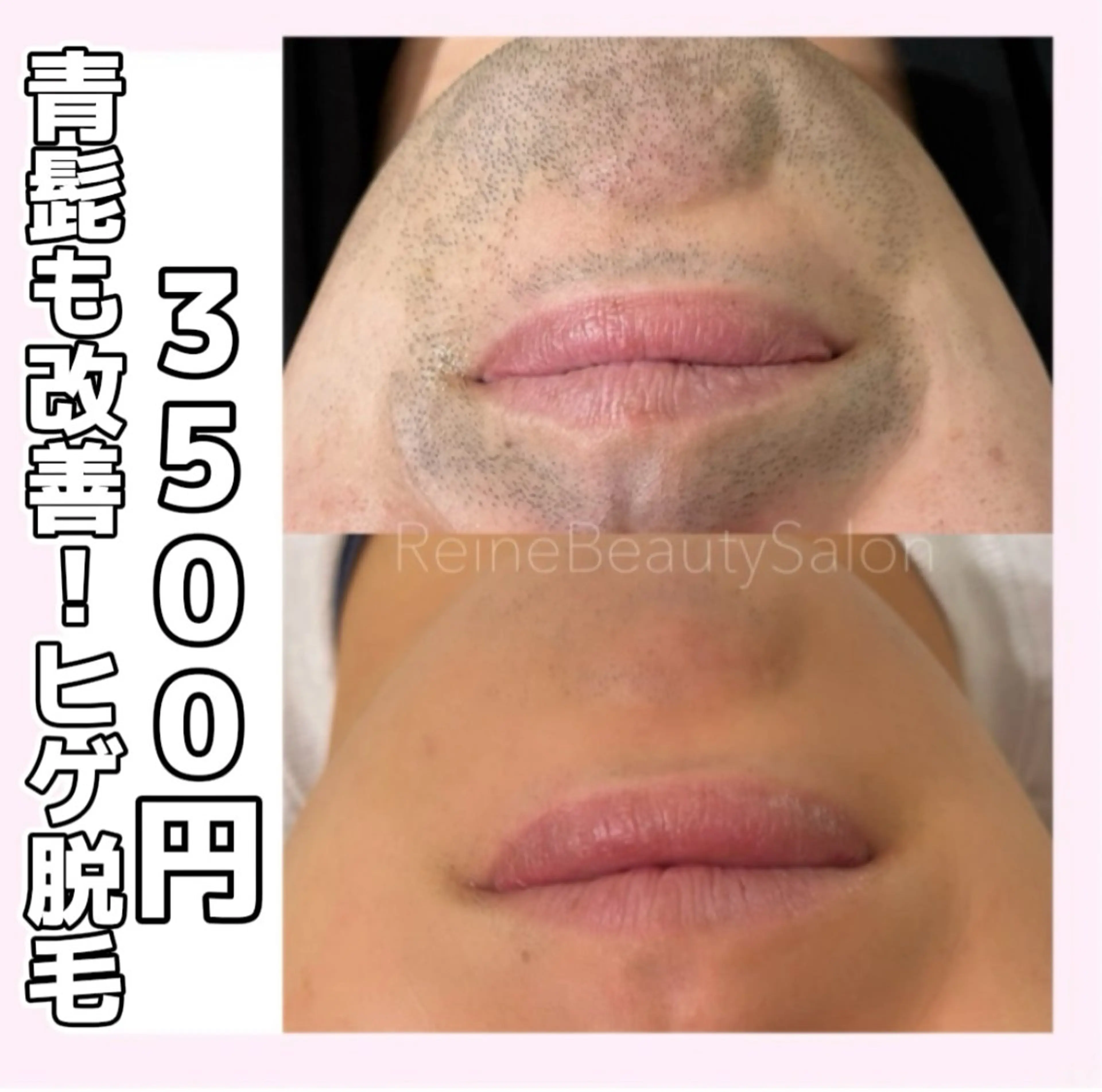 脱毛 Reine BeautySalon所属・毛穴/シミ肝斑/脱毛 横山梨里のエステ・リラクイメージ