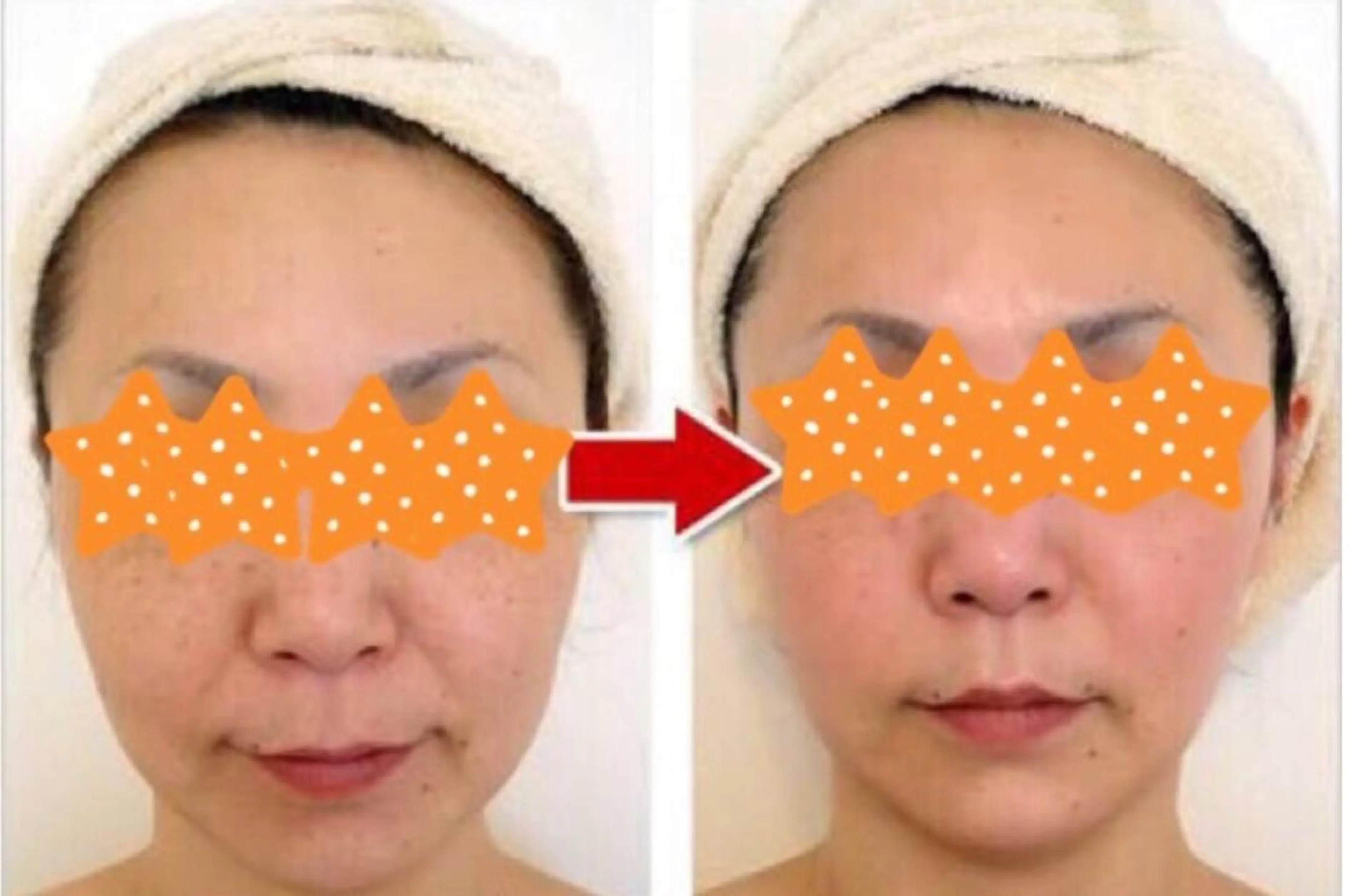 人気のエイジングケア✨しわ/たるみケアのコース⭐️しっかり引き上げます！デコルテ・ヘッドも付いております🥰の写真