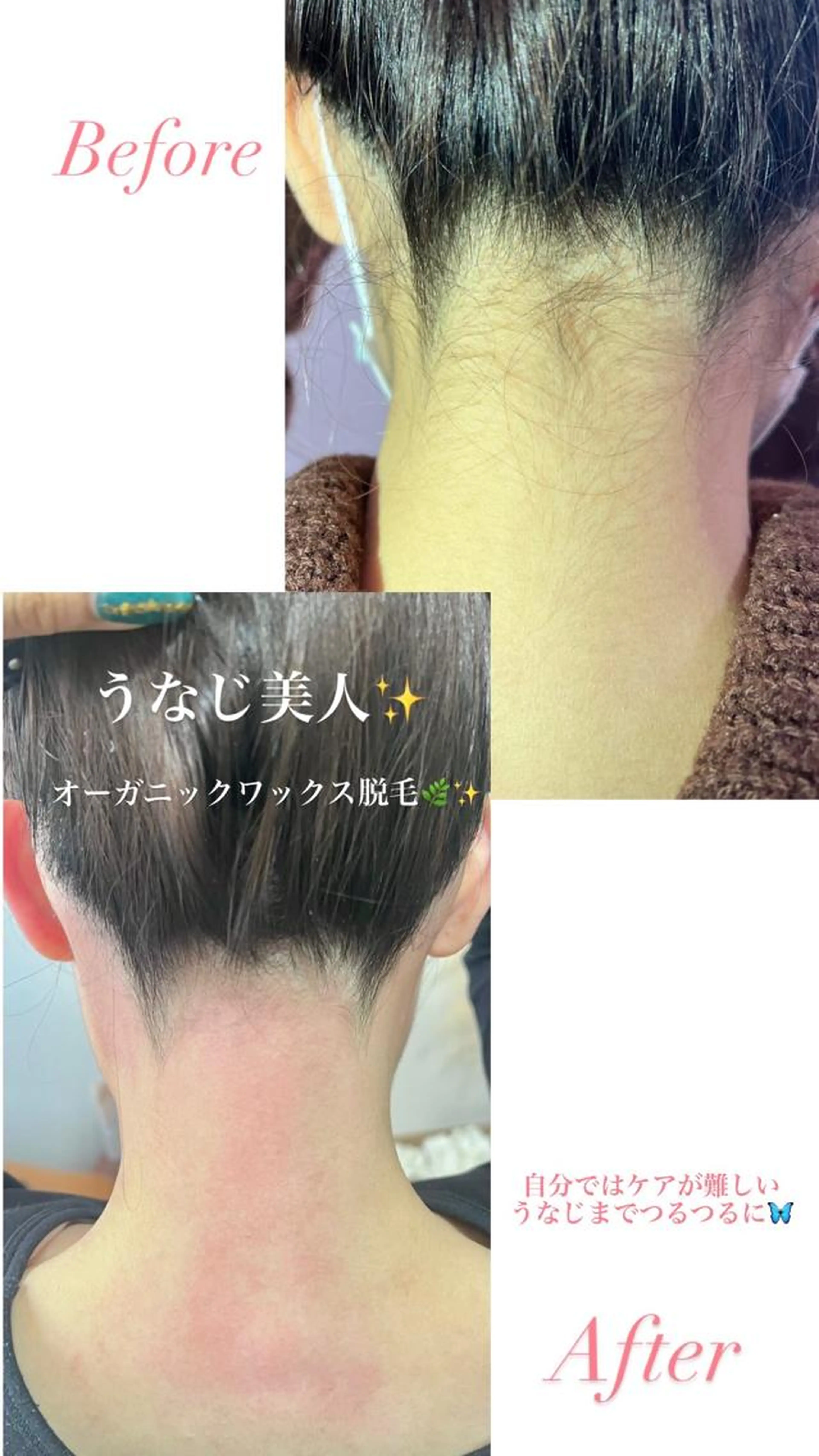 フェイシャル&うなじワックス脱毛セット💆🏼‍♀️✨鎮静CICAパック付き🌿の写真