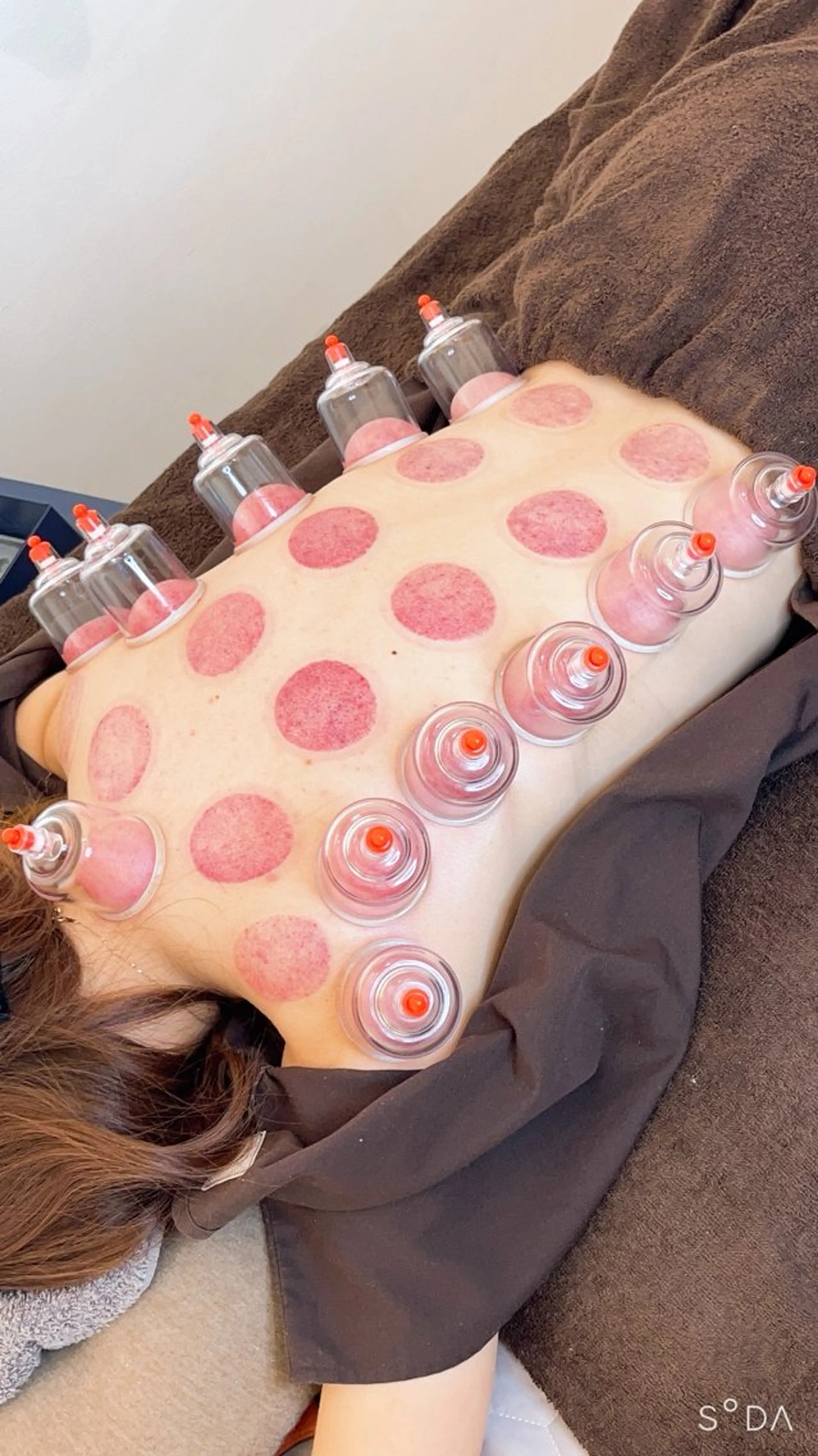 【大人気✨】吸玉(カッピング)🎉の写真