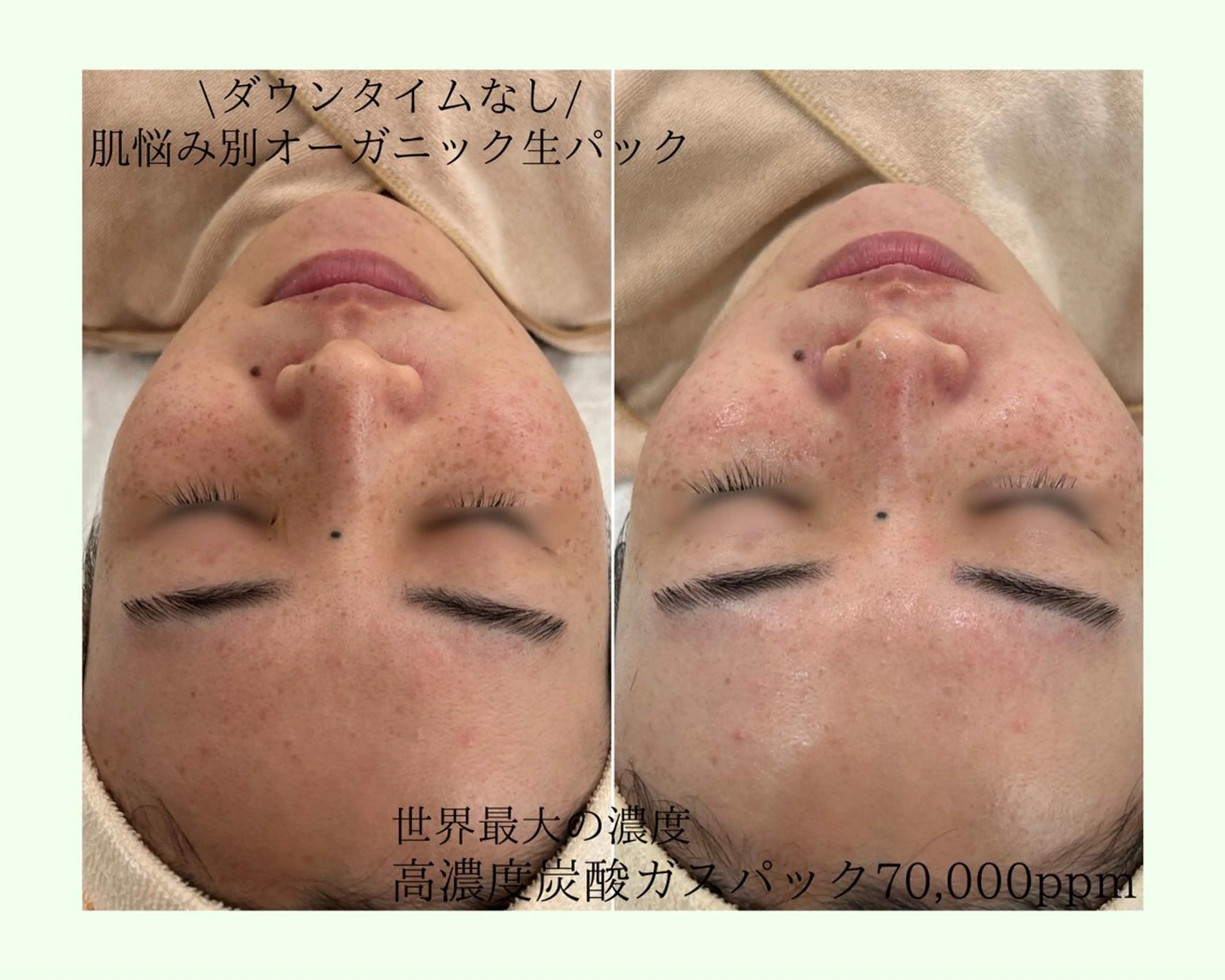 【乾燥に負けない肌作り★毛穴洗浄】乾燥にお悩みの方の写真