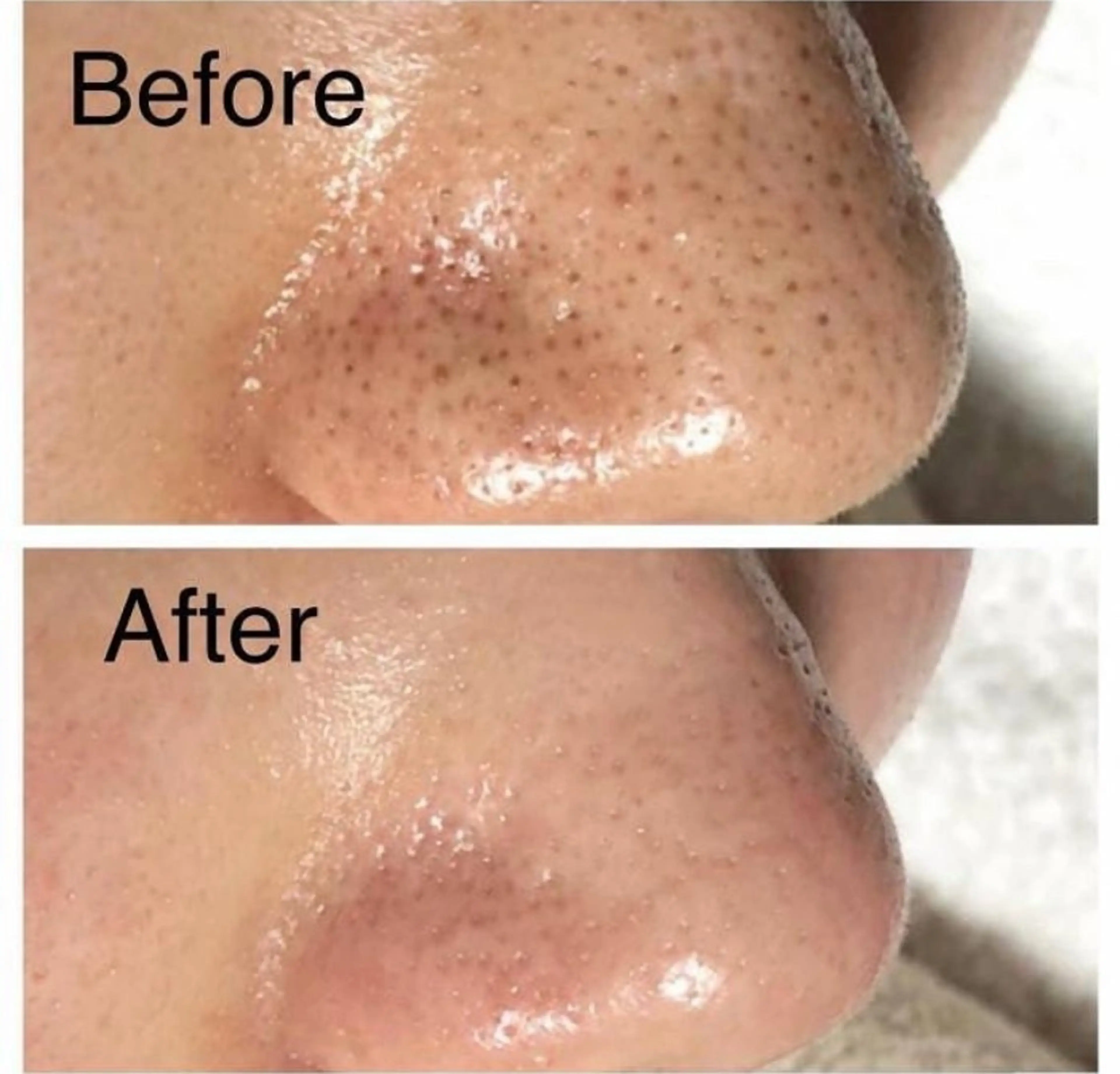 【ご新規様】ごっそり毛穴洗浄ハイドロスプラッシュ 1回¥9,500→¥5,000の写真