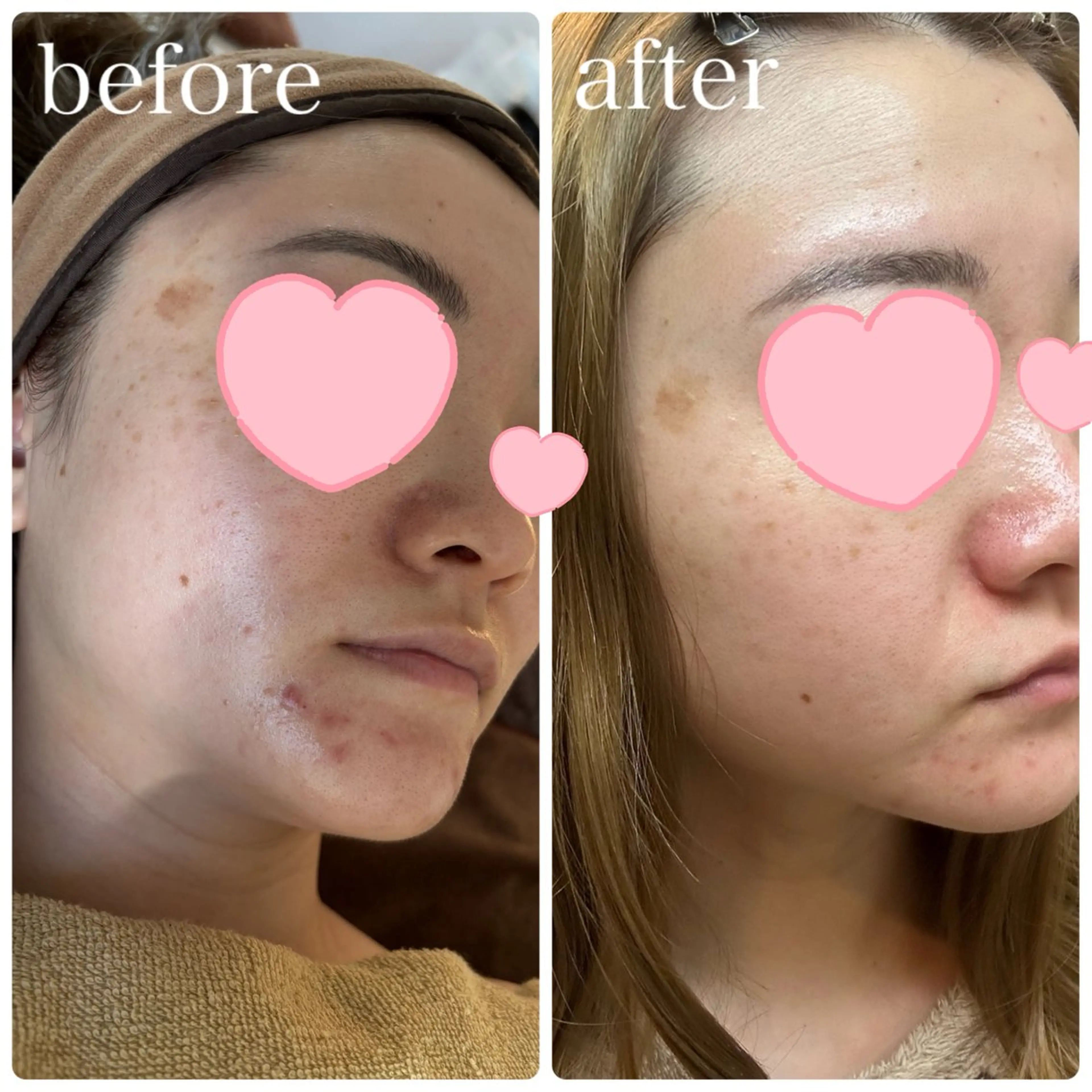 ハーブピーリング🌿 Vivaceのその他イメージ