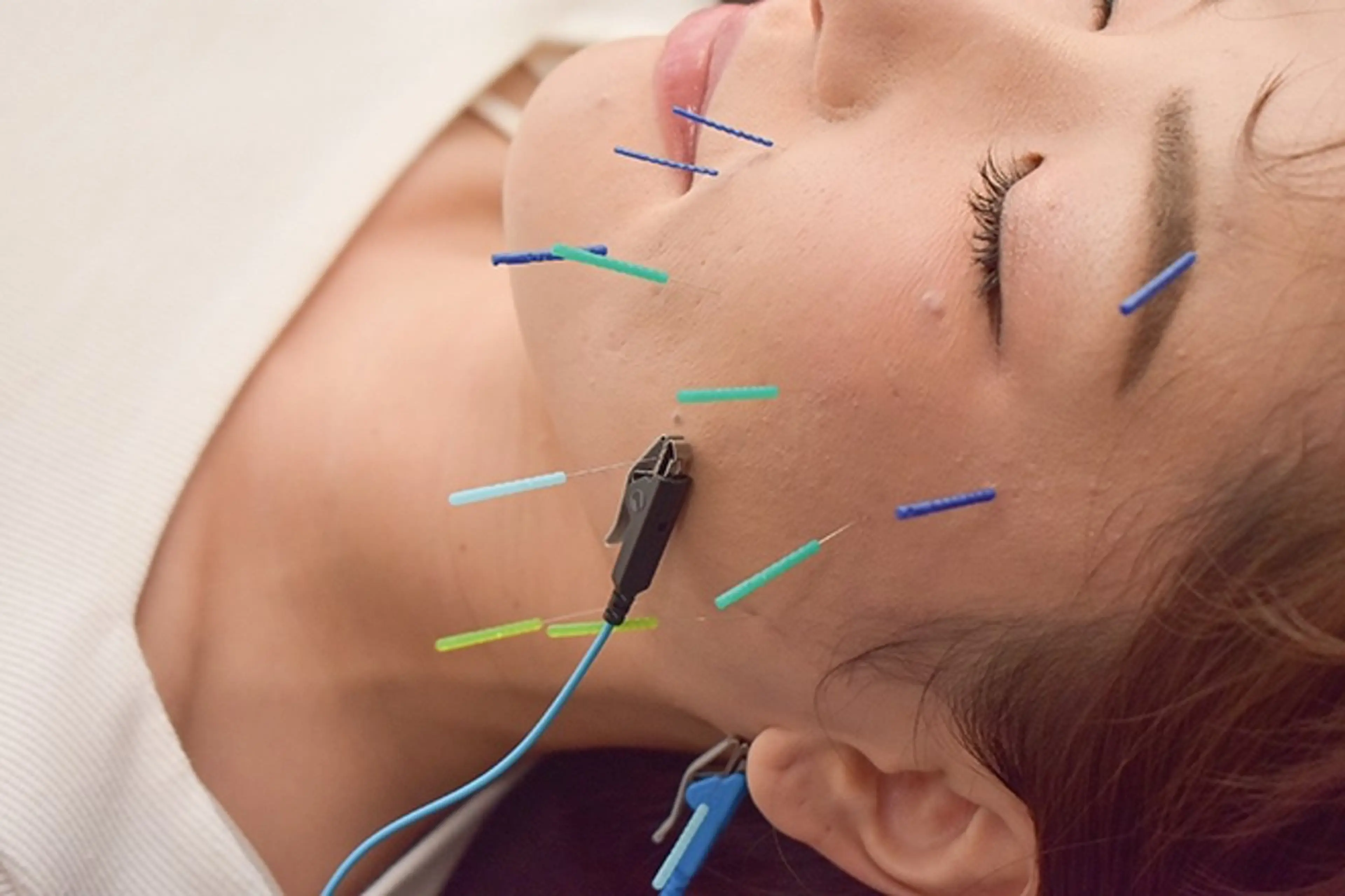 【ミニモ限定価格】むくみ、たるみ解消✨小顔リフトアップ美容鍼（美容鍼+電気+お顔周りのマッサージ）※初診料込みの写真